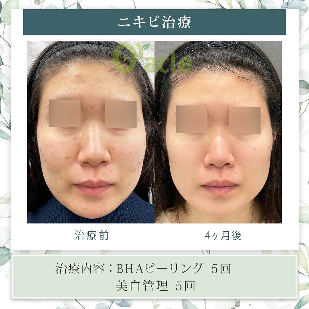 オラクル美容皮膚科東京新宿院のインスタグラム：「◤ニキビ治療症例◢| 《治療内容》 BHAピーリング5回 美白管理5回 繰り返しニキビが出来やすい方は、治療でニキビが治まった場合にも定期的なピーリングで、維持、予防がおすすめです。  ☑️BHAピーリング 高濃度サリチル酸ピーリングです。お肌の表面を殺菌し、繰り返し行うことでニキビはできづらいお肌に改善  【ダウンタイム】▶︎ほぼありません 赤み：数時間 皮剥け:1週間 洗顔、メイクは当日から◎ ⁡ 【料金】 1回　11,000円 ▶︎面ぽう圧出、ゴムパックつき ⁡ ☑️美白管理 ニキビのお肌は乾燥している方が多く、その乾燥がニキビの原因になっているいることも。 美白管理では、お肌の状態に合わせてビタミンＣ、もしくはトラネキサム酸をお肌に導入していきます。 ⁡ 【料金】 1回　11,000円(税込)  ※トラネキサム酸orビタミンC ☞肌状態でお選びいたします。 ⁡ #ピーリング  #ニキビ治療 #ニキビ肌 #ニキビケア　 #韓国美容 #皮膚科　#美容皮膚科 #ニキビ　#ニキビ改善 #コメド　#ニキビ皮膚科」