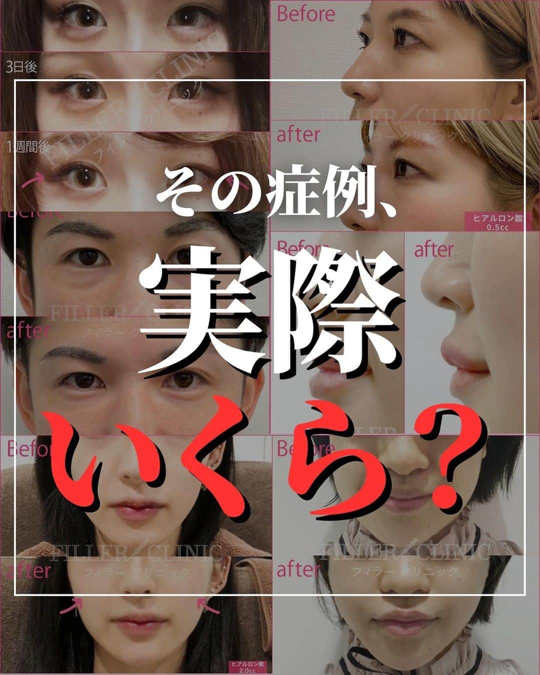 恵比寿フィラークリニックのインスタグラム：「その症例、実際いくら❓ 薬剤・量、全部暴露💣  -------- 《料金・詳細付き症例の受け取り方法》 ①この投稿を保存 ②気になる番をコメントする --------- ※一つずつコメントして下さい。 いっきには送れません(´_ゝ｀)  たったこれだけで 自動でDMが届きます📨  #フィラークリニック #ヒアルロン酸 #cカールリップ #cカールリップならフィラークリニック #スマイルリップ #人中短縮 #中顔面短縮 #鼻ヒアルロン酸 #頬コケ #ムンクフィラー #目の下ヒアルロン酸 #くま #クマ #クマ取り #目の下のクマ #目の下のクマ解消 #たれ目 #たぬきeye #たぬき顔 #美容 #美容男子 #メンズ美容 #涙袋メイク #涙袋ヒアルロン酸 #涙袋ヒアルロン酸ならフィラークリニック #美容マニア #美容マニアと繋がりたい #美容垢 #若返り #若返り美容」