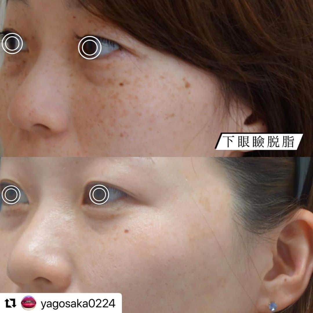 YAG BEAUTY CLINICさんのインスタグラム写真 - (YAG BEAUTY CLINICInstagram)「#Repost @yagosaka0224 with @use.repost ・・・ ・ シミやくすみが改善されてこんなに綺麗なお肌に✨ ・ レーザートーニングは特殊な照射技術が搭載された機械を使用し、シミや色素沈着の症状を増幅させることなく、肝斑を含むあらゆるシミ治療が可能です！  ・ 徐々にシミを小さく砕いていくため、平均で15回〜20回続けて頂くことが必要です🥺💕 一度で劇的な変化はないものの、２週間に1回のペースで通って頂ければ、効果を実感すること間違いなし🫶🏻  シミを無くしたい、お肌の色むらを無くしたい、くすみを無くしたい、などなどあらゆるお悩みを解決！みなさまにおすすめの治療です❤️‍🔥❤️‍🔥❤️‍🔥  少しでも気になる方は是非一度カウンセリングにお越しください！お待ちしております✨  料金💸 1回　¥9,900 10回コース　¥88,000 (1回あたり¥8,800) 15回コース　¥126,000(1回あたり¥8,400) 20回コース　¥160,000(1回あたり¥8,000) ※上記コース価格は全て初診時の料金です  下眼瞼脱脂👀 ¥330,000  #美容クリニック#美容クリニック大阪#ボトックス#ヒアルロン酸 #シミ取り#脂肪吸引#クマ取り#美肌#美白#美肌ケア #美容クリニック梅田#北新地#プチ整形#レーザートーニング#水光注射#ハイフ#ピコレーザー#フラクショナルレーザー#プラズマシャワー#メソガン#毛穴#毛穴改善#たるみ#引き締め#シミ取り #NMN点滴 #アンチエイジング#美容外科#美容皮膚科#美容すきな人と繋がりたい」7月20日 12時30分 - yagbeauty_official