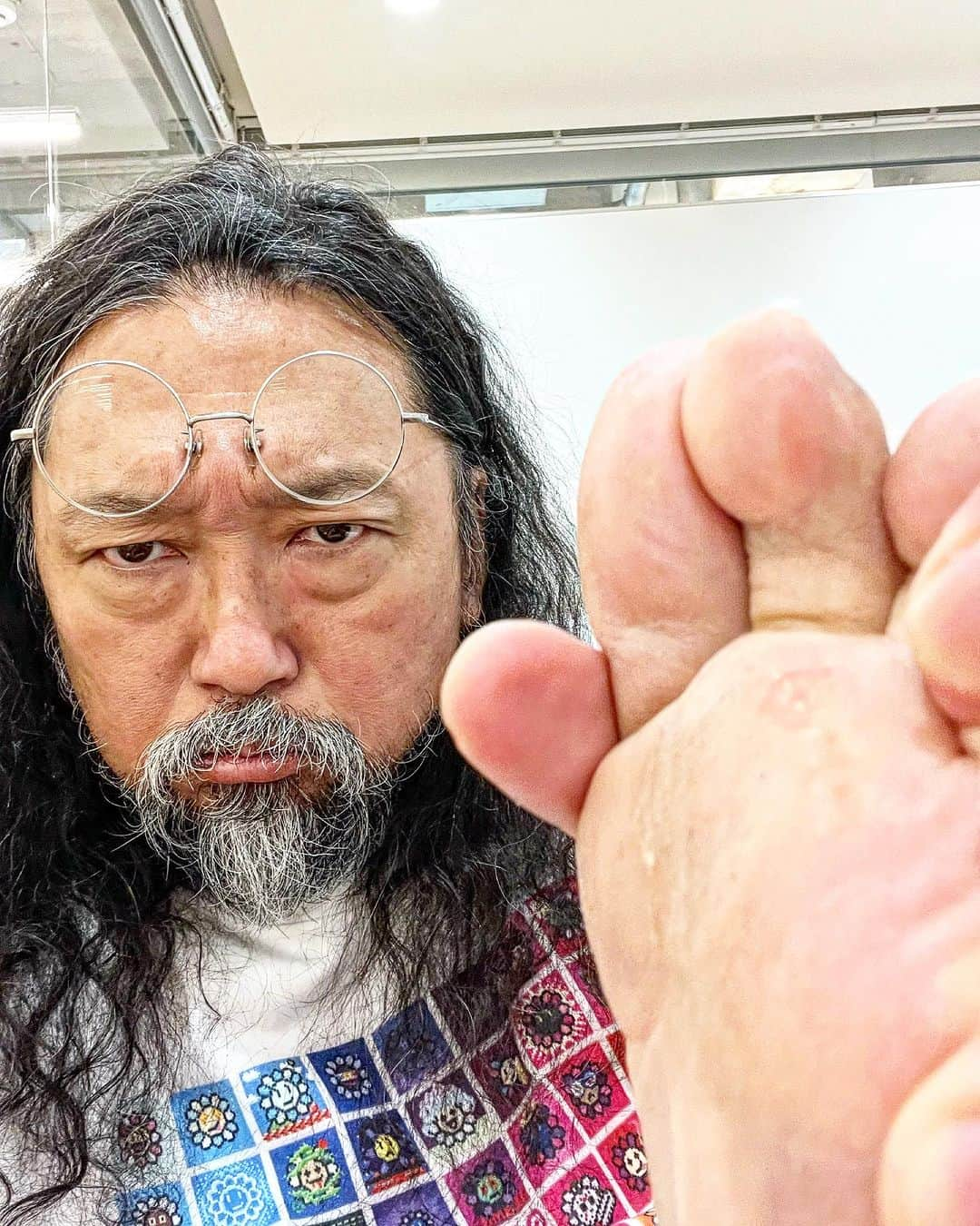 村上隆さんのインスタグラム写真 - (村上隆Instagram)「Today, I went to the hospital for a surgery to remove a corn on my foot that has been bothering me for 25 years! I was very nervous when I went, but the wonderful doctor removed the core of the corn with a deft move of his scalpel!  本日、25年間悩んでた、魚の目を取る手術をする為に！大変緊張して病院に行ったのだが、素晴らしい先生によって、メスでちょっちょっちょっ！と、削ってもらって芯迄取ってもらえました！」7月20日 13時07分 - takashipom