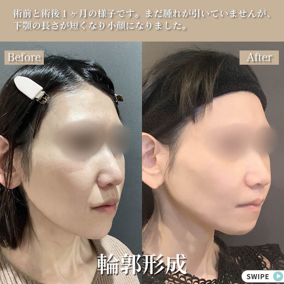 恵聖会クリニックさんのインスタグラム写真 - (恵聖会クリニックInstagram)「. ＼骨切り専門医による輪郭形成／  こちらは ・ルフォー ・下顎輪郭の骨切り ・眼窩下縁（外側） ・頬部前面の骨削り をおこなったモニター様です🥳  元々シャープな印象でしたが、術後は顎が短くなり より小顔になりました🥺  当院では大阪公立大学医学部附属病院形成外科と提携し、 骨切り専門医が執刀しております。 また、麻酔科医も在籍しているため 整った環境の中で手術を受けられます。  無料カウンセリングにてお一人お一人にあった施術をご案内いたします。 ぜひお気軽にご予約・お問い合わせくださいませ🧸  執刀医👨🏻‍⚕️諸富医師  #ルフォー #眼窩下縁 #頬部前面の骨削り #頬骨削り #輪郭3点 #ダウンタイム #輪郭形成 #エラ削り #頬骨削り #オトガイ形成 #骨切り #フェイスライン #形成外科 #3DCT #骨切り #横顔美人 #小顔 #美容好き #美容医療 #美容クリニック #美容外科 #美容皮膚科 #美容整形外科 #大阪美容外科 #大阪美容皮膚科 #恵聖会クリニック」7月20日 11時45分 - keiseikai
