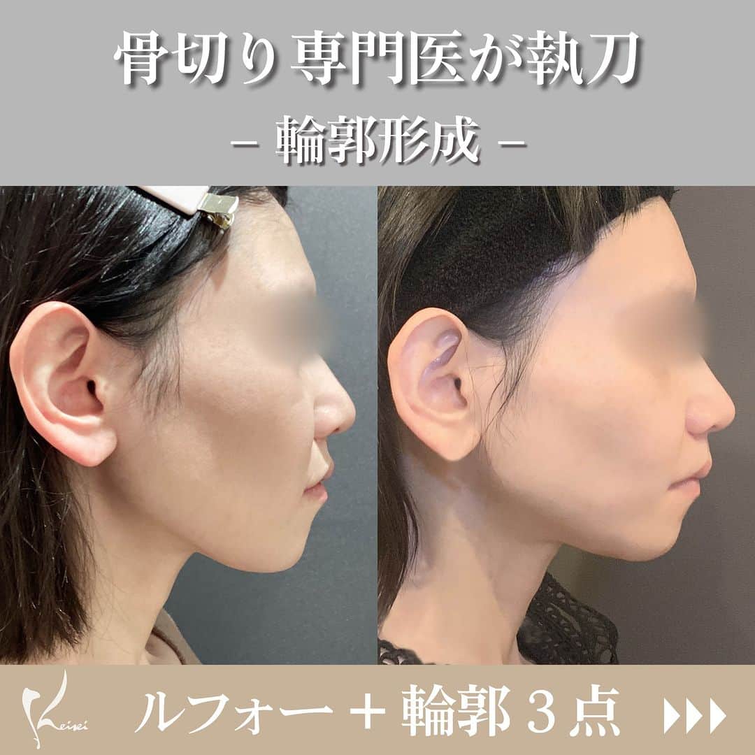 恵聖会クリニックさんのインスタグラム写真 - (恵聖会クリニックInstagram)「. ＼骨切り専門医による輪郭形成／  こちらは ・ルフォー ・下顎輪郭の骨切り ・眼窩下縁（外側） ・頬部前面の骨削り をおこなったモニター様です🥳  元々シャープな印象でしたが、術後は顎が短くなり より小顔になりました🥺  当院では大阪公立大学医学部附属病院形成外科と提携し、 骨切り専門医が執刀しております。 また、麻酔科医も在籍しているため 整った環境の中で手術を受けられます。  無料カウンセリングにてお一人お一人にあった施術をご案内いたします。 ぜひお気軽にご予約・お問い合わせくださいませ🧸  執刀医👨🏻‍⚕️諸富医師  #ルフォー #眼窩下縁 #頬部前面の骨削り #頬骨削り #輪郭3点 #ダウンタイム #輪郭形成 #エラ削り #頬骨削り #オトガイ形成 #骨切り #フェイスライン #形成外科 #3DCT #骨切り #横顔美人 #小顔 #美容好き #美容医療 #美容クリニック #美容外科 #美容皮膚科 #美容整形外科 #大阪美容外科 #大阪美容皮膚科 #恵聖会クリニック」7月20日 11時45分 - keiseikai