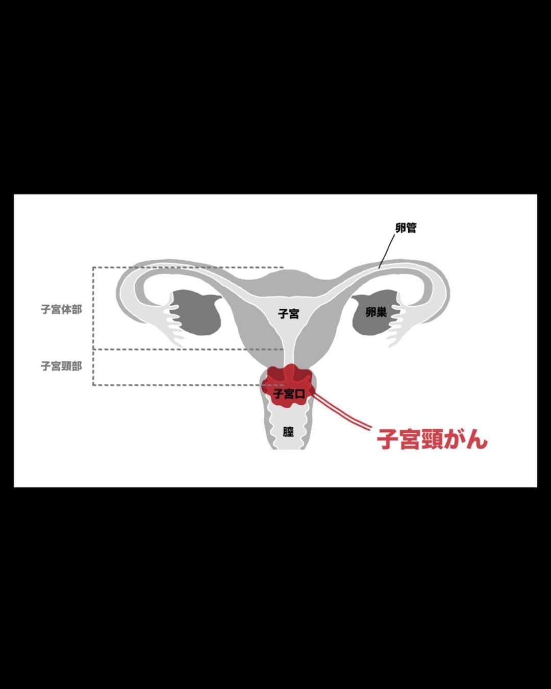 VICE Japanさんのインスタグラム写真 - (VICE JapanInstagram)「#子宮頸部 に発生する〈 #子宮頸がん 〉は、〈ヒトパピローマウイルス（HPV）〉の感染が主な原因とされ、HPVウイルスは、性行為により感染することが知られている。HPVに感染したとしても、多くの女性は自らの免疫力でHPVを体外に排除できるとされている。体外に排出されず長期感染が続いてしまうと、HPVによって〈異常な性格をもった細胞〉がうまれ、その細胞が増殖すると、やがて〈前がん病変〉や子宮頸がんへと移行する。  子宮頸がんを患った女性は、ほとんど症状のない初期には異変に気づかず、病気が進行し自覚症状が現れて初めて病気に気づくケースが多いという。ただし、早期発見できれば治療できる可能性が高いため、いかに早く病気を発見できるかが重要になる。  記事詳細は @vicejapan プロフィールのリンクから  #vicejapan #vice #ヴァイスジャパン」7月20日 19時12分 - vicejapan
