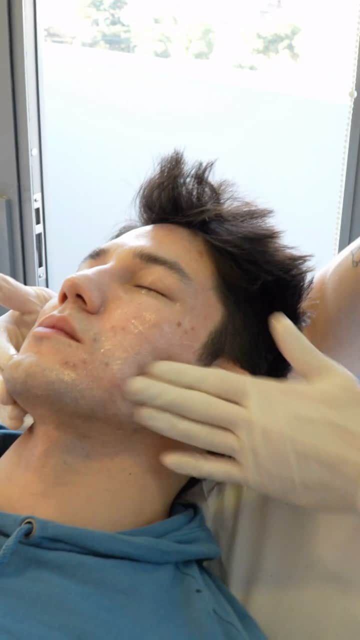 アルトゥール・オヤカワ・マリアノのインスタグラム：「Essa semana fiz um procedimento de Radiesse com o @dr.alvarorao , procedimento que escolhi para trazer mais qualidade a minha pele. Escolhemos o da @merzaesthetics_br , um bioestimulador que reduz intensidade de rugas, expressões faciais e melhora a qualidade de pele. Vou contando pra vocês!🔥 #colageno #dermatologia」