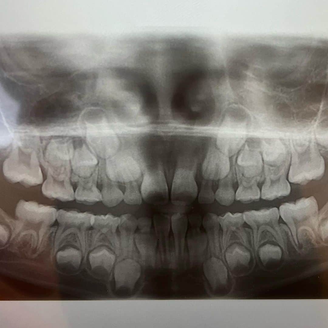 AZUSAさんのインスタグラム写真 - (AZUSAInstagram)「息子6歳の歯のレントゲン。小さなアゴに歯がいっぱい。神秘。」7月21日 13時14分 - azubeatradio