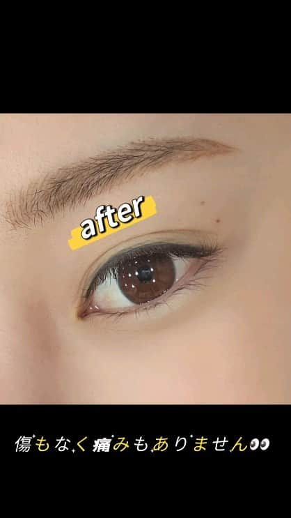 エリナのインスタグラム：「韓国のヒーリング眼科でレーシックをしてきました！ 힐링안과에서 드디어 라식 했어요🥰-0.5>>0.9까지 회복 😍🔥 施術は15-20分ほどで終わり直後はボヤッと目がショボショボ(∋_∈) ６時間後に起きてみると遠くがよく見える👀✨ 翌日にはハッキリと見えて痛みもありませんでした❤️ 今のところ-5.0>>>>0.9まで回復！高校からずっとコンタクトで 大変だったからもっと早くやっとけば良かった☺️☺️ とても親切で 設備がしっかりしてて安心でした！ 🍀質問等お問い合わせは０８リッター公式ラインにお願いします🍀 ラインＩＤ：@879xmszt」