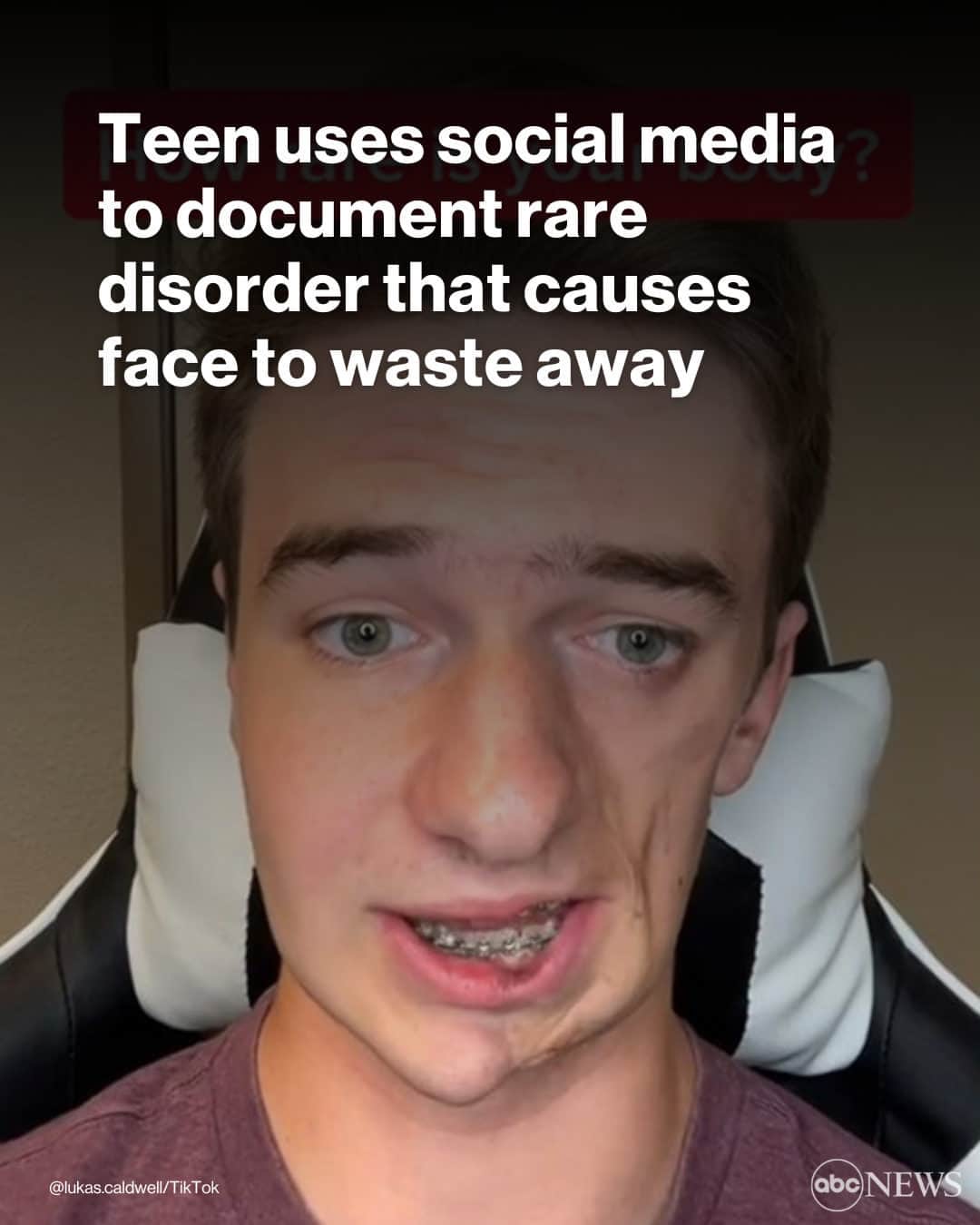 ABC Newsのインスタグラム：「A visit to a dermatologist's office and a skin biopsy led to a life-changing diagnosis of Parry-Romberg syndrome, a rare condition in which the skin and soft tissues on the face slowly deteriorate and waste away. MORE AT LINK IN BIO. #HEALTH #DERMATOLOGY」
