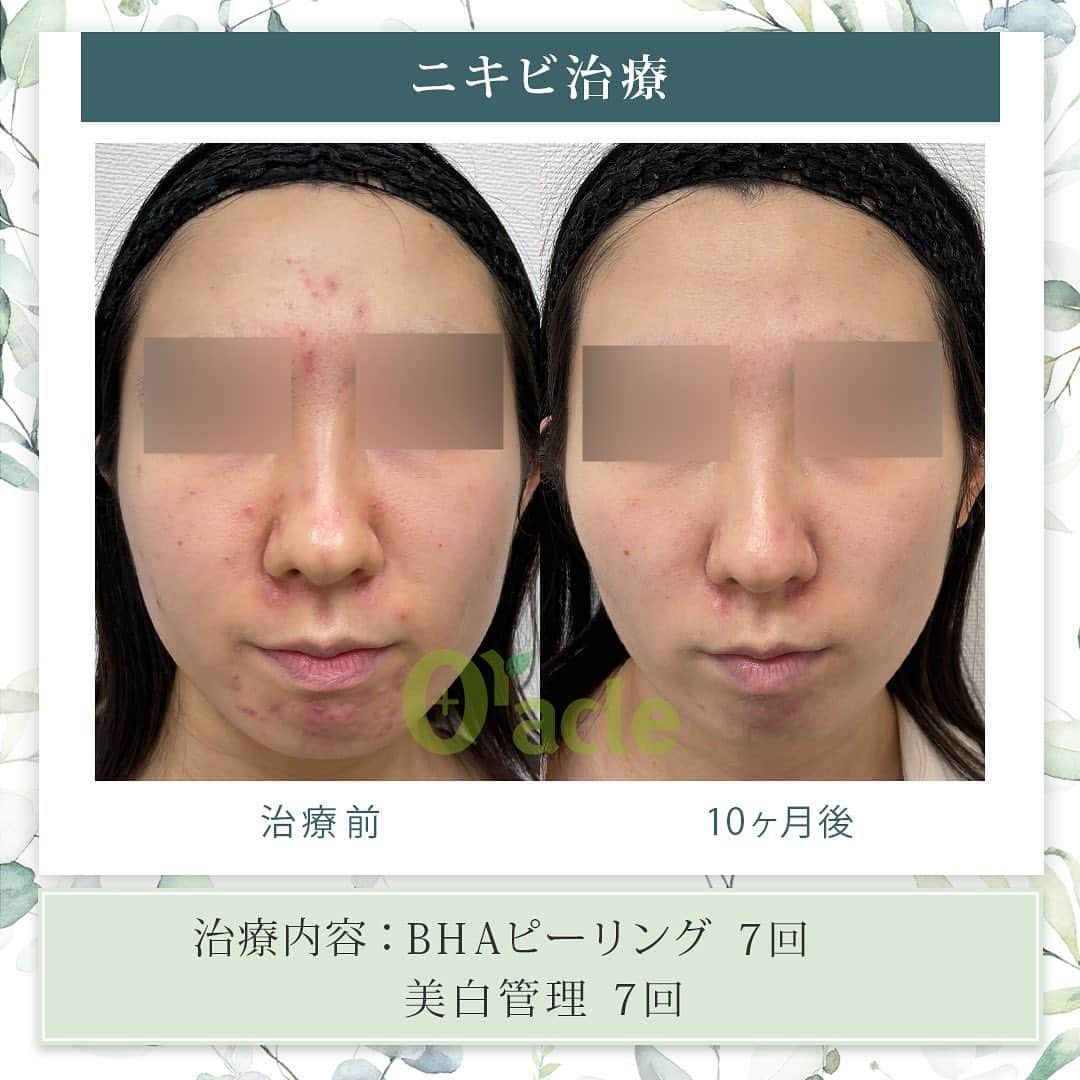 オラクル美容皮膚科東京新宿院のインスタグラム：「◤ニキビ治療症例◢| 《治療内容》 BHAピーリング7回 美白管理7回 繰り返しニキビが出来やすい方は、治療でニキビが治まった場合にも定期的なピーリングで、維持、予防がおすすめです。  ☑️BHAピーリング 高濃度サリチル酸ピーリングです。お肌の表面を殺菌し、繰り返し行うことでニキビはできづらいお肌に改善  【ダウンタイム】▶︎ほぼありません 赤み：数時間 皮剥け:1週間 洗顔、メイクは当日から◎ ⁡ 【料金】 1回　11,000円 ▶︎面ぽう圧出、ゴムパックつき ⁡ ☑️美白管理 ニキビのお肌は乾燥している方が多く、その乾燥がニキビの原因になっているいることも。 美白管理では、お肌の状態に合わせてビタミンＣ、もしくはトラネキサム酸をお肌に導入していきます。 ⁡ 【料金】 1回　11,000円(税込)  ※トラネキサム酸orビタミンC ☞肌状態でお選びいたします。 ⁡ #ピーリング  #ニキビ治療 #ニキビ肌 #ニキビケア　 #韓国美容 #皮膚科　#美容皮膚科 #ニキビ　#ニキビ改善 #コメド」