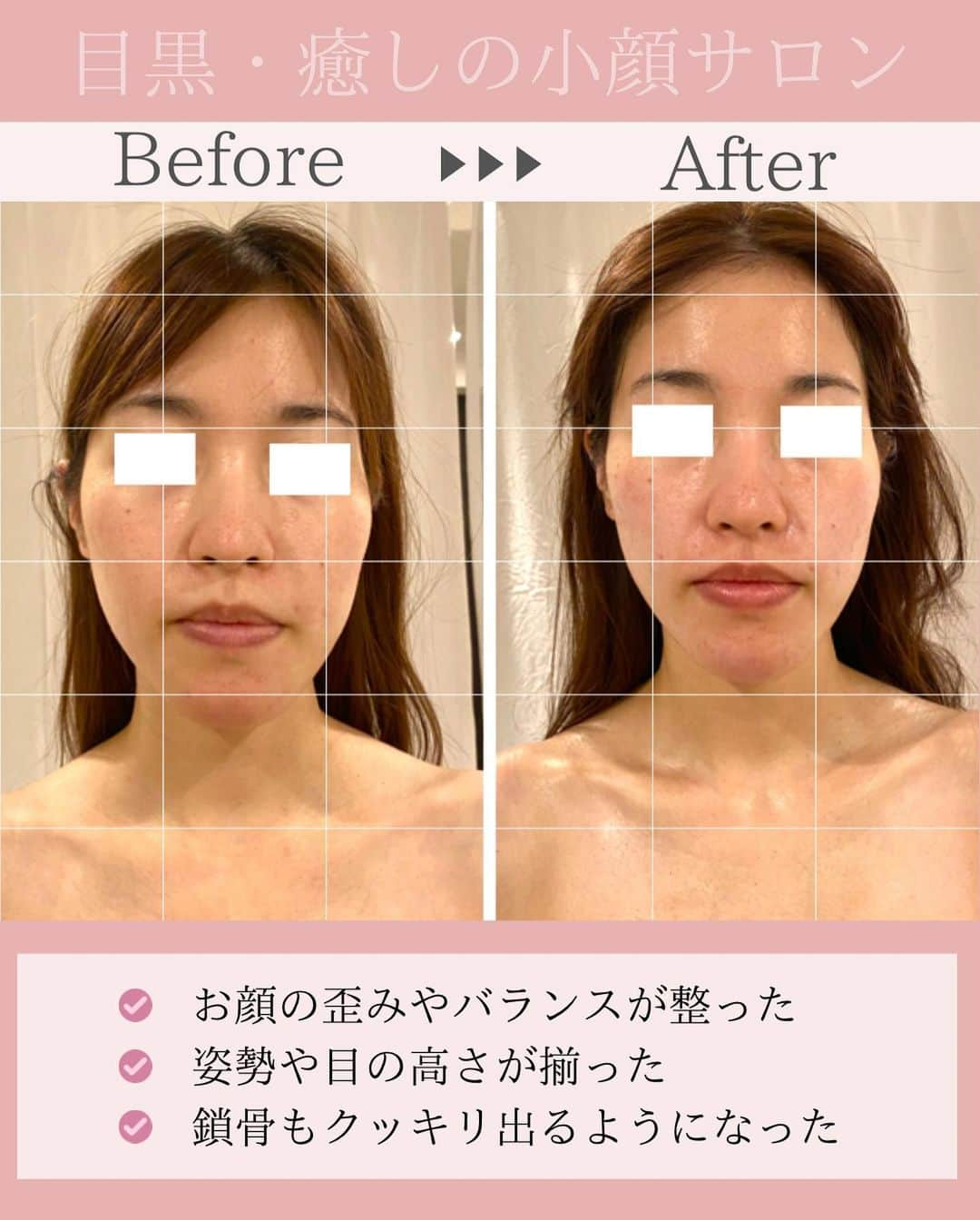 Eternal Total Beauty Salonさんのインスタグラム写真 - (Eternal Total Beauty SalonInstagram)「.  【特別な日を1番輝く自分で迎える】  当サロンにはこれから挙式や 前撮りの撮影があるお客様も 沢山いらして下さってます☺️  小顔矯正はこんな方にもおすすめです。  ◎ブライダルを控えている ◎前撮りがある ◎近々大切な予定がある ◎イベントがある  それぞれの特別な日に 最高のコンディションで迎えるための お手伝いをさせていただきます🤍  施術も痛みゼロでお肌にも 安心・安全なので 終始リラックスして受けて頂けますよ✨  _  【小顔効果倍増なペース】 ＊初回から含めて3回目までは週1から空けても 　2週に1回のペースを推奨しております。 　最初に土台を作り戻りにくく定着させる為です。 ⁡ ご新規様は3回分のご予約をオススメ致します。 トップページのHPから承っております🙇‍♀️ ⁡ ⁡ ⁡ ＊＊＊＊＊＊＊＊＊＊＊＊＊＊＊＊＊＊＊＊ ⁡ ⁡ 小顔矯正/インディバ ⁡ ⁡ 営業時間　11:00〜20:00(18:30最終受付) ⁡ 定休日　不定休 ⁡ ⁡ ご予約はトップページのURLから🙇‍♀️✨ 【@beautylian_kogao】 ⁡ ＊＊＊＊＊＊＊＊＊＊＊＊＊＊＊＊＊＊＊＊ ⁡ #小顔矯正東京 #小顔矯正 #小顔矯正サロン  #顔痩せ #小顔になりたい #リフトアップ #プレ花嫁東京 #花嫁美容 #目黒駅  #目黒小顔矯正 #垢抜け #自分磨き」6月29日 15時37分 - kogao_beautylian