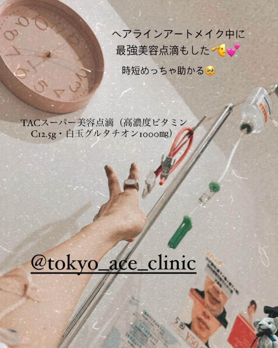 難波サキさんのインスタグラム写真 - (難波サキInstagram)「-𝐇𝐚𝐢𝐫 𝐀𝐑𝐓 𝐌𝐀𝐊𝐄  薄毛が気になりすぎてずっとやりたかった ヘアラインのアートメイクしたよ✨  アートメイクで有名なクリニック🏥 📍@artmake_by_tokyoaceclinic  担当はTOKYO ACE CLINIC @matsui_tokyoace_artmake  さんだよ💁🏼‍♀️  デザインも上手でめっちゃナチュラルな仕上がりでやってよかった美容医療ランキング入り🫶🏻 ビフォーアフター恥ずかしいけど載せますね😂  アイブロウも人気らしくてトップアーティストさんがいる クリニックだから予約埋まりやすいので気になる人はお早めに🥰  なんと❗️ 私のインスタみたで予約したら20%OFFしてくれるそうです💛 20%offはおっきいよね💛 アイブロウが一番人気らしいよ✨   アートメイク中に白玉点滴もできて 一石二鳥嬉しい🫶🏻  ︎#artmake_by_tokyoaceclinic #tokyo_ace_clinic #アートメイク#アラフォー美容  #アイブロウ#ヘアラインアートメイク」6月30日 11時28分 - sakinanba