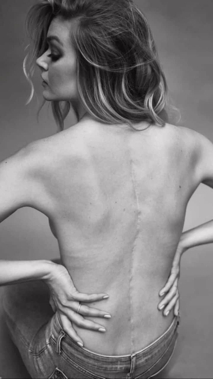 リンジー・エリンソンのインスタグラム：「My #scoliosis story in 30 seconds! I’m so happy to say scoliosis hasn’t stopped me from doing anything, if anything I am stronger for it. Early detection is key with scoliosis. When I was younger, I remember my school screening for scoliosis started years after I was diagnosed. Some visible signs for me were uneven shoulders, shoulder blade sticking out and visible curves when bending over. I hope this post helps anyone who is going through bracing and/or spinal fusion. Leave any questions below and remember you are stronger than you know! 🤍💪🏻✨ #scoliosisawarenessmonth」