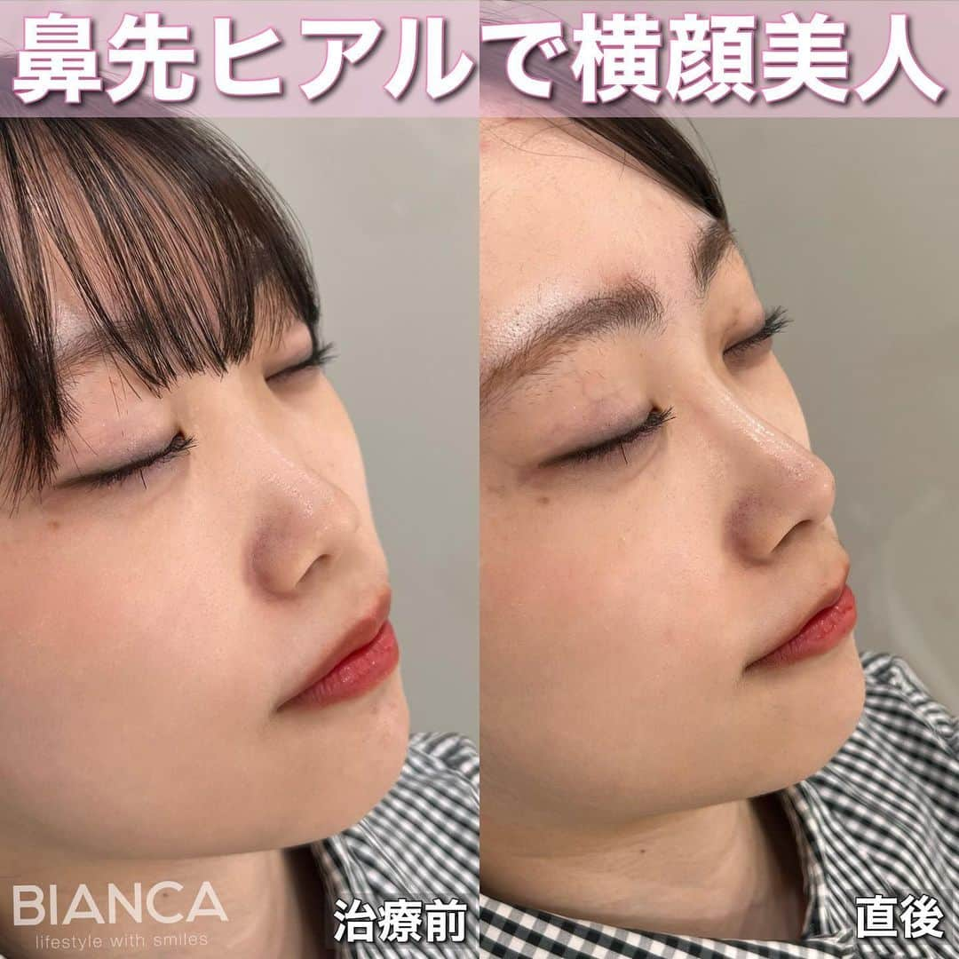 辻沢由有（BIANCA CLNIC 表参道院 院長）さんのインスタグラム写真 - (辻沢由有（BIANCA CLNIC 表参道院 院長）Instagram)「#dryuuヒアル　 【ヒアルロン酸でさらに美人へ✨】  治療時間、約10分👏 ヒアルロン酸でお顔を更に洗練🎉  どうなりたいかわからない方も こだわりがたくさんある方も 綺麗になりたい方、お任せください🥰  ✽.｡.:*・ﾟ ✽.｡.:*・ﾟ ✽.｡.:*・ﾟ ✽.｡.:*・ﾟ ✽.｡.:*・ﾟ  ✔︎鼻先〜鼻筋ヒアルロン酸 レスチレンリフト 1ml  107,800円＋税 別途施術料　22,000円＋税  ⏳治療時間: 10分 🗓持続期間: 1〜2年 😷腫れ・内出血: 数日程度 ⚠️リスク: 感染・血流障害・凹凸など  ✽.｡.:*・ﾟ ✽.｡.:*・ﾟ ✽.｡.:*・ﾟ ✽.｡.:*・ﾟ ✽.｡.:*・ﾟ  📝ご予約はwebが便利です✨ プロフィール欄のリンクからご予約ください。 ※医師指名可能（“大久保医師指名”をクリック） ※診察料はかかりません🙅‍♀️ ※表参道院勤務が9割となっています。  📍BIANCA CLINIC ※お電話頂くと自動音声通話に繋がります。 ✔︎表参道院 ☎️05018071593 東京都港区南青山5-11-10  南青山511ビル 2F ✔︎銀座院 ☎️05031964834 東京都中央区銀座1-8-19 キラリトギンザ12F  •診療時間 10:00〜19:00 •年中無休（年末年始を除く）   ✽.｡.:*・ﾟ ✽.｡.:*・ﾟ ✽.｡.:*・ﾟ ✽.｡.:*・ﾟ ✽.｡.:*・ﾟ  #鼻ヒアルロン酸 #鼻整形 #鼻先ヒアルロン酸 #eライン #横顔美人 #ヒアルロン酸」7月1日 16時55分 - i_am_yuu__