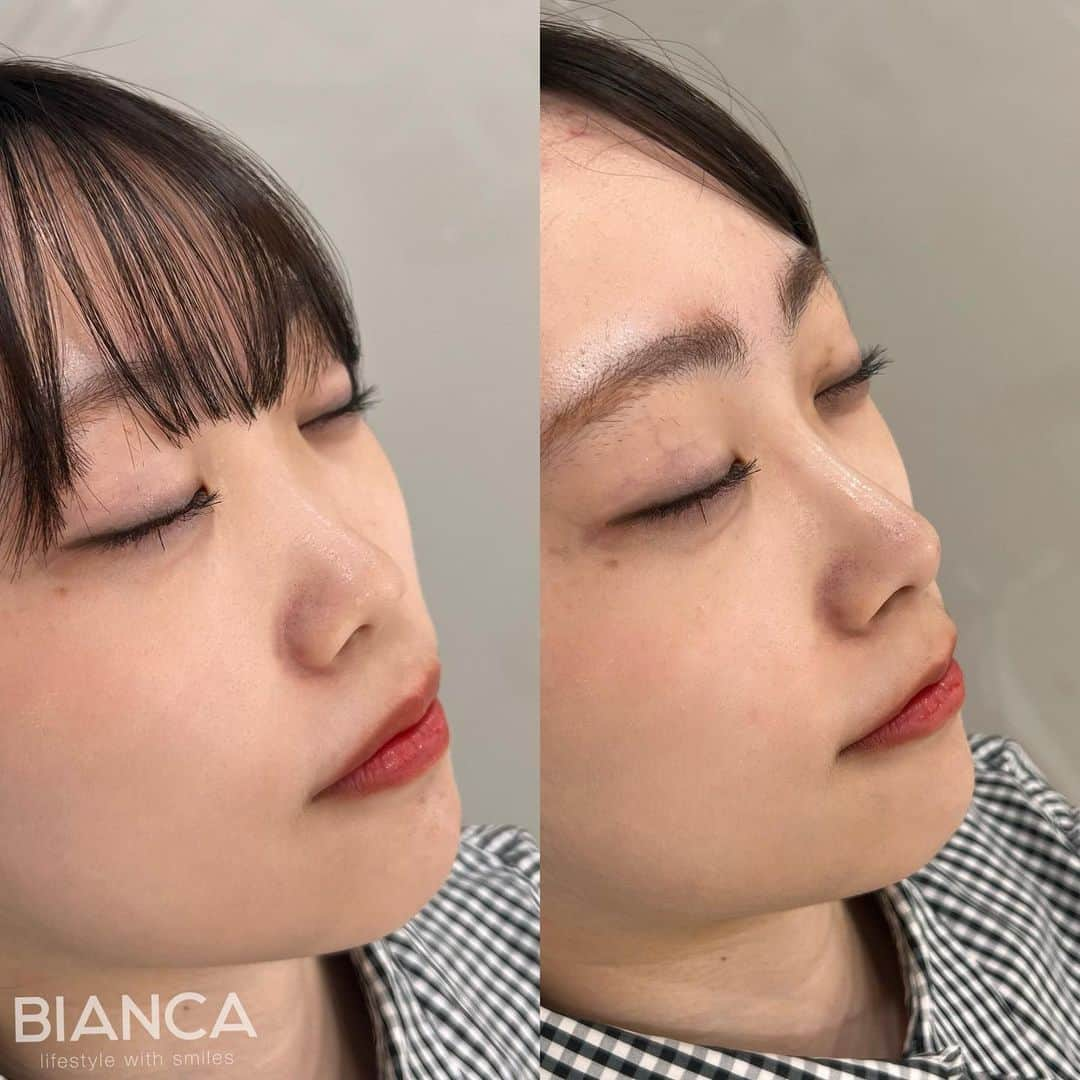 辻沢由有（BIANCA CLNIC 表参道院 院長）さんのインスタグラム写真 - (辻沢由有（BIANCA CLNIC 表参道院 院長）Instagram)「#dryuuヒアル　 【ヒアルロン酸でさらに美人へ✨】  治療時間、約10分👏 ヒアルロン酸でお顔を更に洗練🎉  どうなりたいかわからない方も こだわりがたくさんある方も 綺麗になりたい方、お任せください🥰  ✽.｡.:*・ﾟ ✽.｡.:*・ﾟ ✽.｡.:*・ﾟ ✽.｡.:*・ﾟ ✽.｡.:*・ﾟ  ✔︎鼻先〜鼻筋ヒアルロン酸 レスチレンリフト 1ml  107,800円＋税 別途施術料　22,000円＋税  ⏳治療時間: 10分 🗓持続期間: 1〜2年 😷腫れ・内出血: 数日程度 ⚠️リスク: 感染・血流障害・凹凸など  ✽.｡.:*・ﾟ ✽.｡.:*・ﾟ ✽.｡.:*・ﾟ ✽.｡.:*・ﾟ ✽.｡.:*・ﾟ  📝ご予約はwebが便利です✨ プロフィール欄のリンクからご予約ください。 ※医師指名可能（“大久保医師指名”をクリック） ※診察料はかかりません🙅‍♀️ ※表参道院勤務が9割となっています。  📍BIANCA CLINIC ※お電話頂くと自動音声通話に繋がります。 ✔︎表参道院 ☎️05018071593 東京都港区南青山5-11-10  南青山511ビル 2F ✔︎銀座院 ☎️05031964834 東京都中央区銀座1-8-19 キラリトギンザ12F  •診療時間 10:00〜19:00 •年中無休（年末年始を除く）   ✽.｡.:*・ﾟ ✽.｡.:*・ﾟ ✽.｡.:*・ﾟ ✽.｡.:*・ﾟ ✽.｡.:*・ﾟ  #鼻ヒアルロン酸 #鼻整形 #鼻先ヒアルロン酸 #eライン #横顔美人 #ヒアルロン酸」7月1日 16時55分 - i_am_yuu__