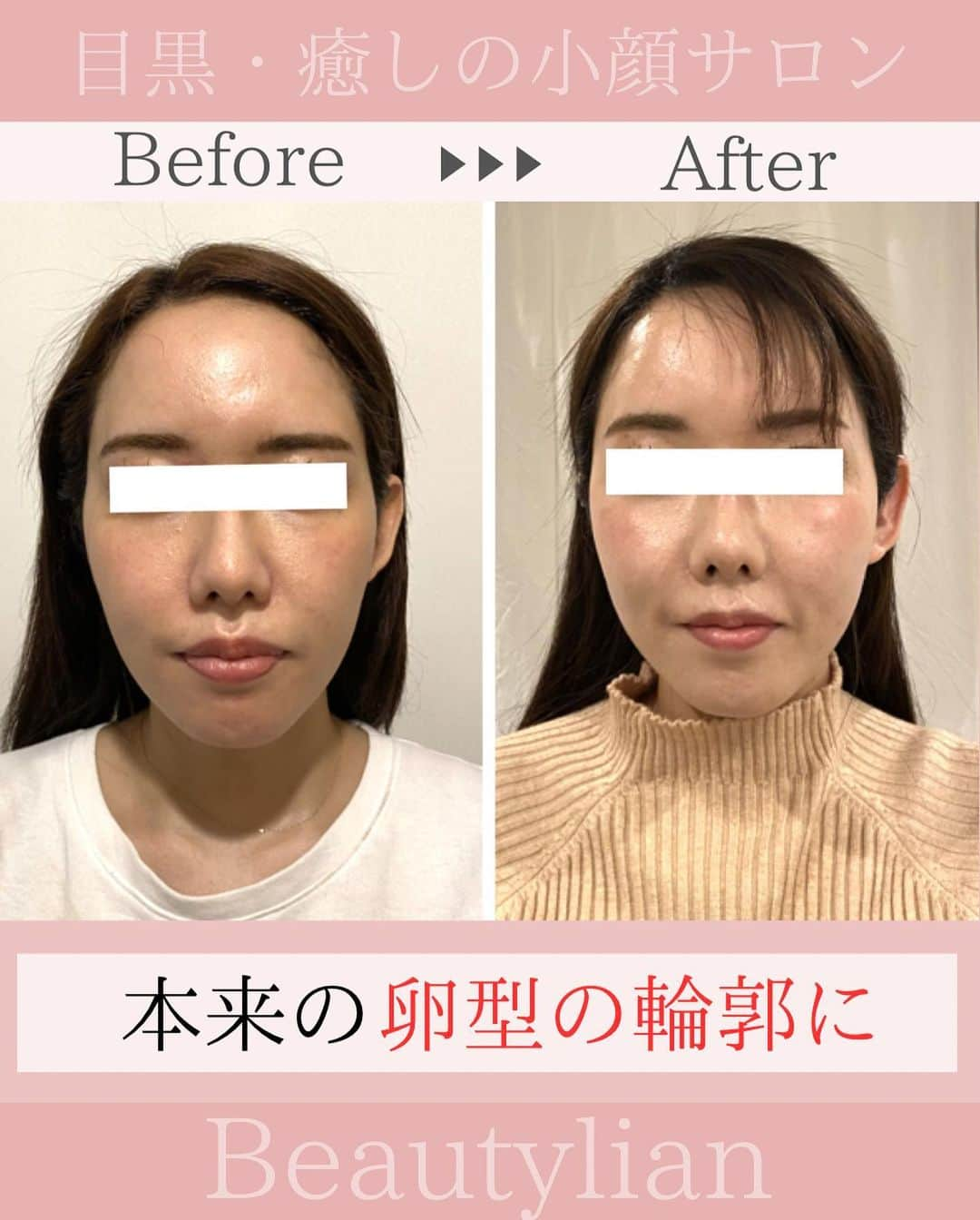 Eternal Total Beauty Salonのインスタグラム：「.  【本来の綺麗な卵型に】  前に出ていたお顔が 正しい位置に戻り綺麗な卵型に✨  昔は卵型だったのに... 顔が大きくなったと感じる...  このようなお悩みも 小顔矯正で解決できます。  当店の小顔矯正では弱い圧で じんわりとお顔を変えて行きますので、 戻りにくく長持ちします。  さらに終わった直後から 翌日にかけて どんどんお顔が変わって行きます☺️  1人1人に寄り添い、一緒に なりたいお顔に近づけるよう 施術させていただきます✨  _  【小顔効果倍増なペース】 ＊初回から含めて3回目までは週1から空けても 　2週に1回のペースを推奨しております。 　最初に土台を作り戻りにくく定着させる為です。 ⁡ ご新規様は3回分のご予約をオススメ致します。 トップページのHPから承っております🙇‍♀️ ⁡ ⁡ ⁡ ＊＊＊＊＊＊＊＊＊＊＊＊＊＊＊＊＊＊＊＊ ⁡ ⁡ 小顔矯正/インディバ ⁡ ⁡ 営業時間　11:00〜20:00(18:30最終受付) ⁡ 定休日　不定休 ⁡ ⁡ ご予約はトップページのURLから🙇‍♀️✨ 【@beautylian_kogao】 ⁡ ＊＊＊＊＊＊＊＊＊＊＊＊＊＊＊＊＊＊＊＊ ⁡ #小顔矯正東京 #小顔矯正 #小顔矯正サロン  #顔痩せ #小顔になりたい #リフトアップ #プレ花嫁東京 #花嫁美容 #目黒駅  #目黒小顔矯正 #垢抜け #自分磨き#卵型小顔」