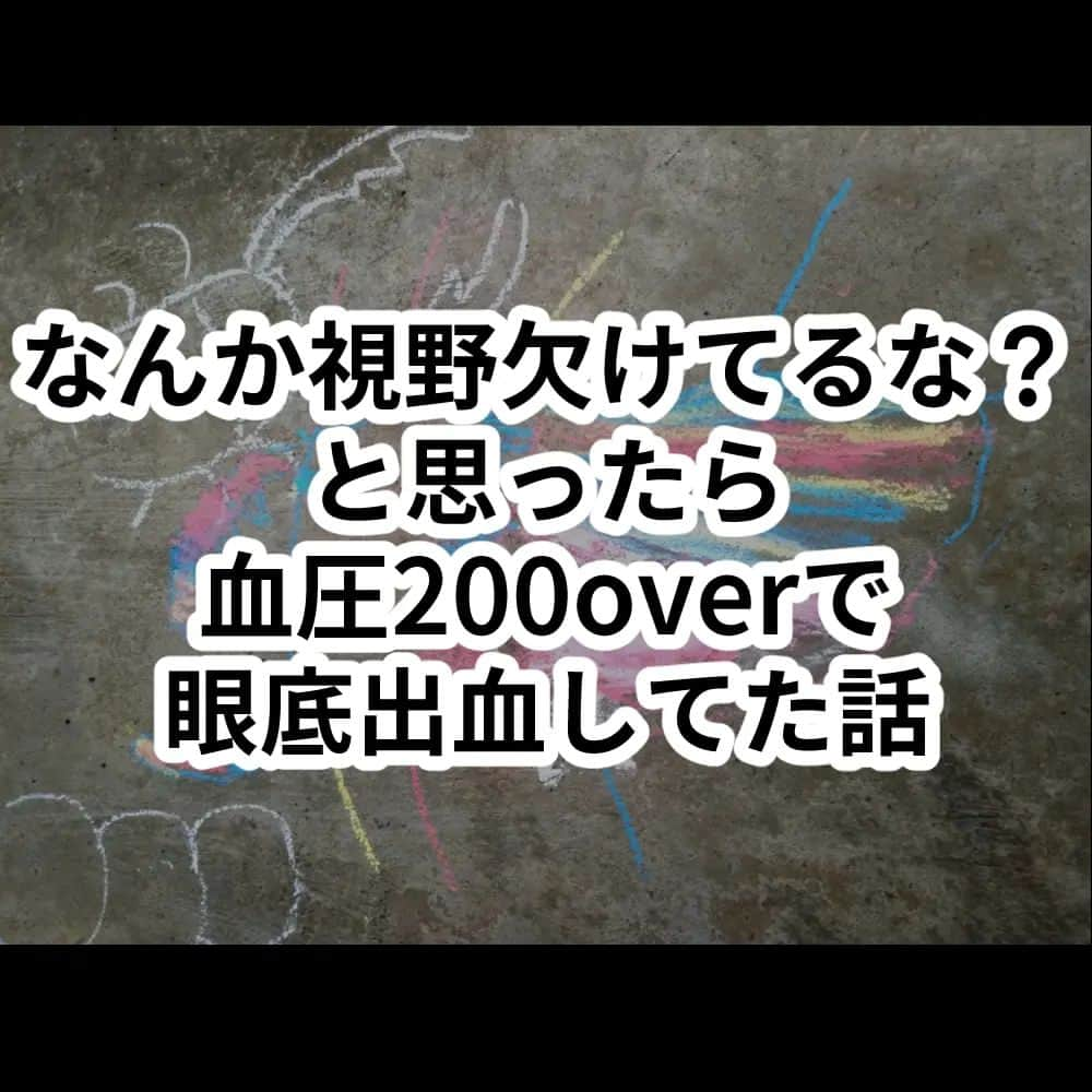 たんこのインスタグラム：「6月の上旬、突然あずき粒くらいのでっかい飛蚊症が発生し、なんだろ〜？と思っていたら、2日後に視野に違和感。 右目の下半分が見えない。はっきりとした欠損という感じではなく、強い光を見た後の黒い抜け落ちがずっと続いている感じでした。 長年ステロイド治療をしていて緑内障のリスクはあったので、すぐに眼科を受診。すると、  「眼底出血してるね。これ、5mmズレてたら失明してたよ。」  え…？😇  原因は色々あるけど、たぶん高血糖が高血圧が原因じゃないかと…。確かに、この2つは最近またステロイドが増えてから上がり気味。  また血圧管理せねば…と思い、自宅の血圧計を使ってみたところ故障が判明。 翌日、珍しく夫が休んでくれたので、二人で家電量販店に血圧計を買いに行きました。 試しに測ったりしながら。  血圧、216/155   ……ん？😇😇  夫「リハ中止！リハ中止ーー！！」  そのまま、循環器内科にぶち込まれる。  そんなわけで、その後、言語障害が出てきたり、降圧剤が効かなくて救急車で運ばれたり、今も歌は歌えない状態だったり、色々ありましたが、なんとか持ち直しました。  なんというか、本当に運が良くて、受診した先々での先生がとっても良い先生ばかりで、助かりました。 何より、夫がPTでよかった。数値みせれば焦ってくれるタイプのPTでよかった。  子どもたちには、とても不安な思いをさせてしまいました。 以前搬送された時は救急車に喜んでいた息子も、母が死ぬかもしれないという不安を抱くまで成長していました。離れていた時間のぶんまで、いっぱい抱きしめました。  今年に入り持病が悪化してしまい、今回の騒動もステロイドが増えた影響ではあるのですが、私は幸いにもデブの高血圧です。 痩せれば、ちょっとは抗える。  というわけで、今年は本気で絞ります！ もう、半分終わったけど、今年… 長生きして、さらに成長した子どもたちを見るために。 ふわふわ〜♥って言われて喜んでる場合じゃない！！  まあ、ステロイドパワーで、ダイエットもなかなか一筋縄ではいかないのですが😂 （精進料理を食べていても生活習慣病になる世界らしい） あと、規則正しい生活。最近、無茶をして徹夜続きだったのも大いに関係していました。  自分の身体と向き合って、自分を大切にします。 大切な家族のために。 皆さんも、ちょっとでも違和感を感じたら、ぜひ受診を！  #指定難病 #難病ママ #高血圧 #ステロイド #ステロイド副作用 #眼底出血 #視野欠損 #ダイエット #変わるチャンス！ #写真は息子の #ニジイロクワガタ」