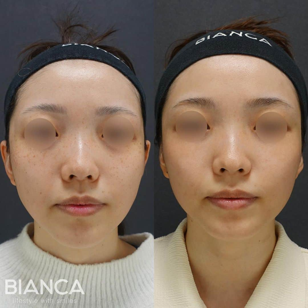 辻沢由有（BIANCA CLNIC 表参道院 院長）さんのインスタグラム写真 - (辻沢由有（BIANCA CLNIC 表参道院 院長）Instagram)「#dryuu肌 ▶︎swipeで文字なし写真▶︎ 【これぞBIANCAメソッド🌟】  左 治療前 右 スポット照射 ＋トーニング5回後  シミが綺麗になったのはもちろん 回を重ねるごとに見違えるほど トーンアップ＆肌質も改善しています✨  1人で悩んでいる時間はもったいないです❗️😵 気になる方は是非カウンセリングにお越しください👩‍⚕️  🌸ピコスポット全顔打ち放題 税込 17,908円 🌸ピコトーニング 税込 118,580円 🌸各種栄養療法 🌸スキンケア指導  ✽.｡.:*・ﾟ ✽.｡.:*・ﾟ ✽.｡.:*・ﾟ ✽.｡.:*・ﾟ ✽.｡.:*・ﾟ  📝ご予約はwebが便利です✨ プロフィール欄のリンクからご予約ください。 ※医師指名可能（“大久保医師指名”をクリック） ※診察料はかかりません🙅‍♀️ ※表参道院勤務が9割となっています。  📍BIANCA CLINIC ※お電話頂くと自動音声通話に繋がります。 ✔︎表参道院 ☎️05018071593 東京都港区南青山5-11-10  南青山511ビル 2F ✔︎銀座院 ☎️05031964834 東京都中央区銀座1-8-19 キラリトギンザ12F  •診療時間 10:00〜19:00 •年中無休（年末年始を除く）   ✽.｡.:*・ﾟ ✽.｡.:*・ﾟ ✽.｡.:*・ﾟ ✽.｡.:*・ﾟ ✽.｡.:*・  #美容外科 #美容皮膚科 #美容整形 #美肌  #アンチエイジング  #ピコシュア #ピコトーニング  #シミ取り #そばかす #シミ治療  #ソバカス #スキンケア #美白」7月2日 17時16分 - i_am_yuu__