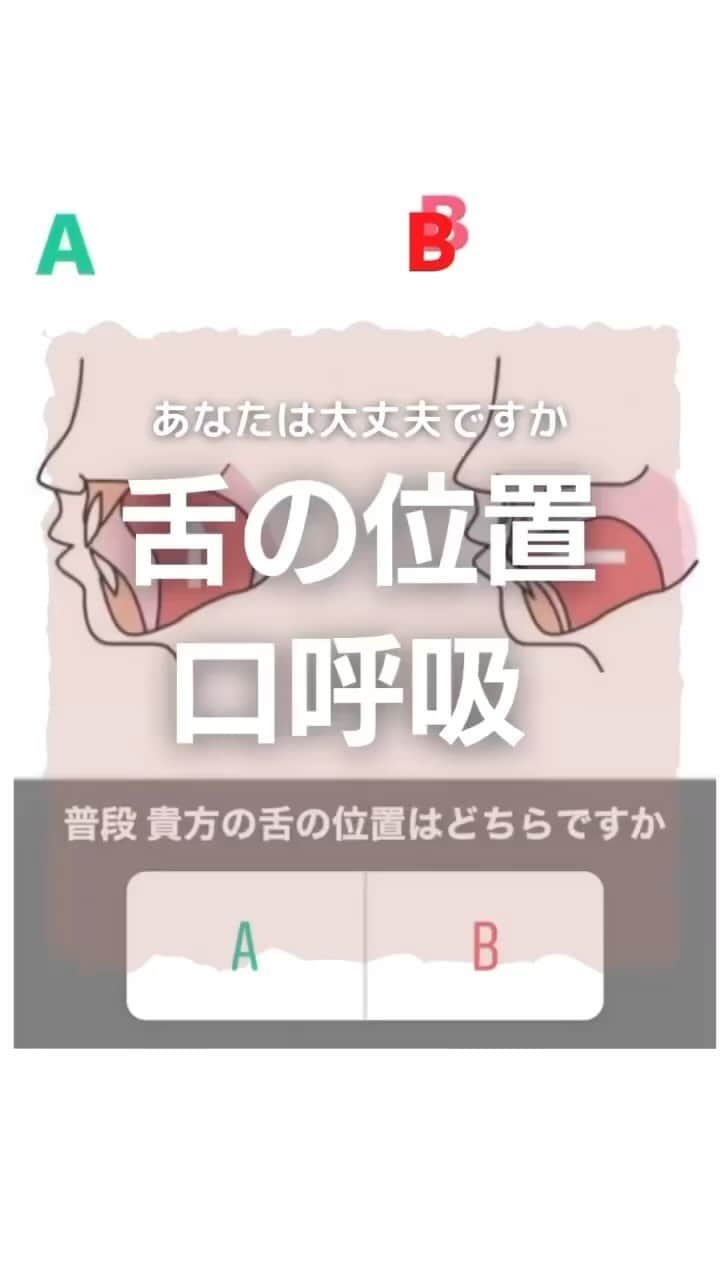 kogao283のインスタグラム：「舌の位置  大丈夫ですか？  #意外に知られていない口呼吸の弊害と鼻呼吸の重要性について  鼻の呼吸では、空気の通り道が狭く、 ゆっくり吸気されるため、取り入れられる空気は温められ、 水分も含むようになります。  さらに、鼻とのどとの境目にある扁桃組織 （咽頭扁桃、アデノイドともいう）に 花粉やウイルス、ハウスダストなどが付着することで、  #免疫機能が働き異物を排除すると考えられています👃🏻  つまり、鼻で呼吸することで、  #冷たく乾燥した外気が加温・加湿されるとともに、  #異物が気管支や肺に直接取り込まれることも 避けられるわけです☝️  　ところが口呼吸では、 外気がそのまま取り込まれるため、 口の中や気道が乾燥し、 のどに炎症や痛みが起こったり、 のどの両脇にある扁桃腺（口蓋扁桃）の腫れ などが起きやすくなります。  また異物やウイルスも直接侵入するため、 インフルエンザなどの感染症にも罹りやすくなります。  　鼻がつまって口呼吸になると、 「のどがヒリヒリする」「のどがカラカラに乾燥する」 と感じますが、 鼻呼吸によって取り入れる空気は、 柔らかく、湿度を持っていて温かいのです。 そのことからも鼻呼吸の良さが分かります。  口呼吸が引き起こす体の不調  　最近は、口呼吸の弊害に注目し、 「口呼吸が病気の原因となっている」という見地に立って、 治療と並行し鼻呼吸を指導する医師が増えています。   　様々な体の不調は、口呼吸が原因であることも想定されるため日ごろから鼻呼吸に切り替えるよう努めることが大切です。  また、身体の不調以外にも 歯並びや顎の変形も、、、  .  LINE ｢@kogao283｣ @マーク含む  #口呼吸 #低位舌#歯の矯正 #アデノイド顔貌」