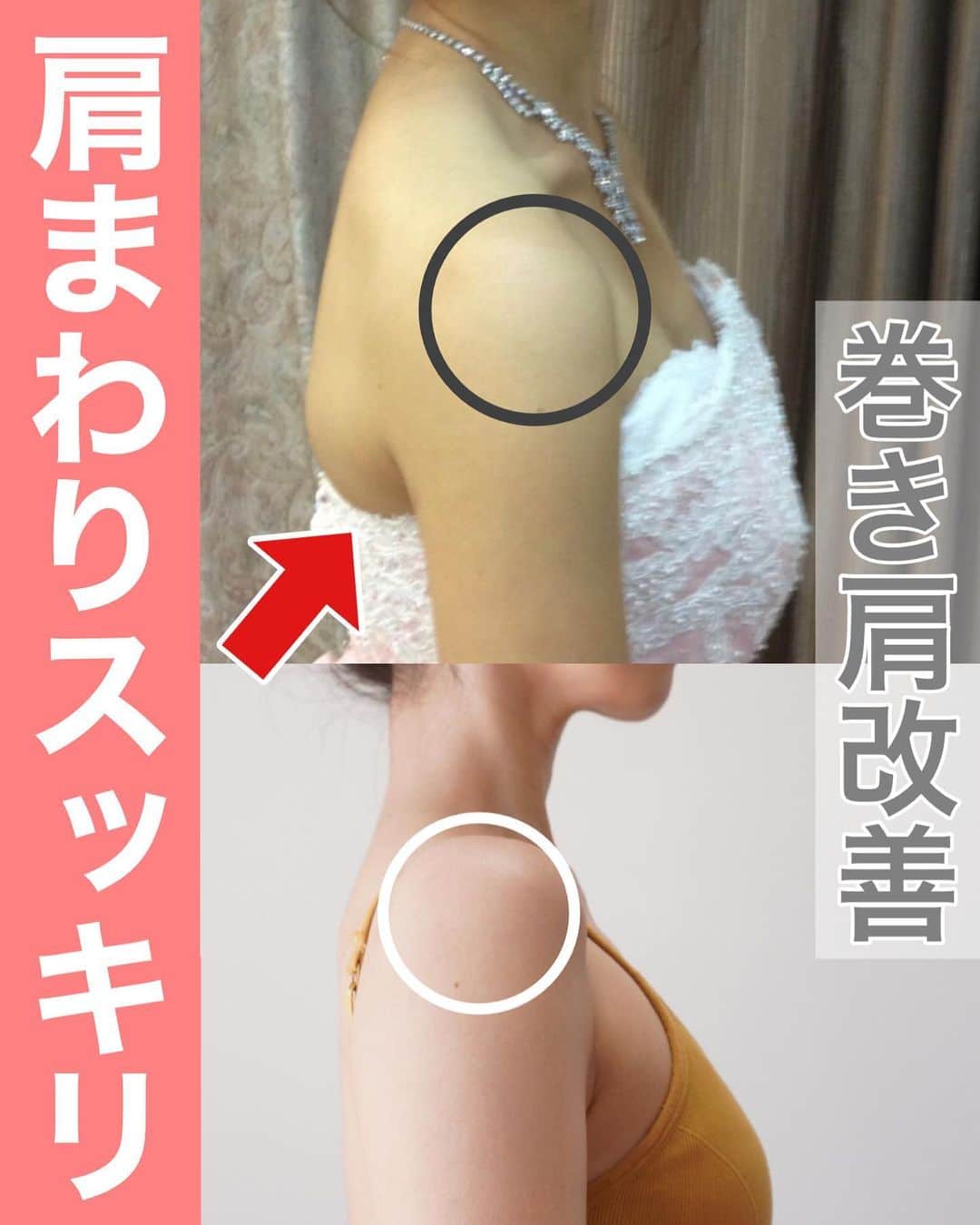 佐川裕香のインスタグラム：「巻き肩改善・姿勢で変わること  日常生活ではほとんど、腕を前で、手の平は下で過ごすことが多くなるので自然と肩は内巻きに。  まずはがむしゃらに鍛える前に、 硬くなった筋肉、過剰に働く筋肉を抑制させていきましょう😊  巻き肩だから外巻きではなく、 腕の骨が内にも外にも捻れることも重要✔︎  股関節が内旋すると肩関節も内旋しやすい.. 頭が前に出て、親指ばかり使えば 肩は内に巻きやすくなる..  小さな積み重ね、習慣で からだの連鎖をどんどん良い方向へ導いていきましょう✨  ✔︎7月2週目のオンラインレッスン・上半身クラスは『巻き肩を改善〜デコルテ美人〜』をテーマにレッスンを進めていきます✨  6月の肋骨、肩甲骨アプローチと組み合わせてぜひお試しください😊  --------------------------------------------  根本からからだを変えていきたい方の為の オンラインレッスン🌍  ▶︎募集期間 →7/6 (木)23:59まで‼️  ✔︎お申込みいただいたその日から 過去２ヶ月分のレッスンアーカイブを視聴可能 ✔︎9割以上の方がアーカイブのみでご参加下さっています  プロフィールのURL、MOSHサイトから お申込み受付けさせて頂きます✨  --------------------------------------------  We are accepting applications for monthly online lessons! For more information, please visit the instgram URL✨  https://mosh.jp/services/107752  Languages are here ●Subtitle languages↓ *May be English only in some areas  English/한국어/繁體中文/‎العربية/Italiano Bahasa Indonesia/Svenska/Español/ไทย/Deutsch/Türkçe Français/Tiếng Việ/ Português/Русский  --------------------------------------------」