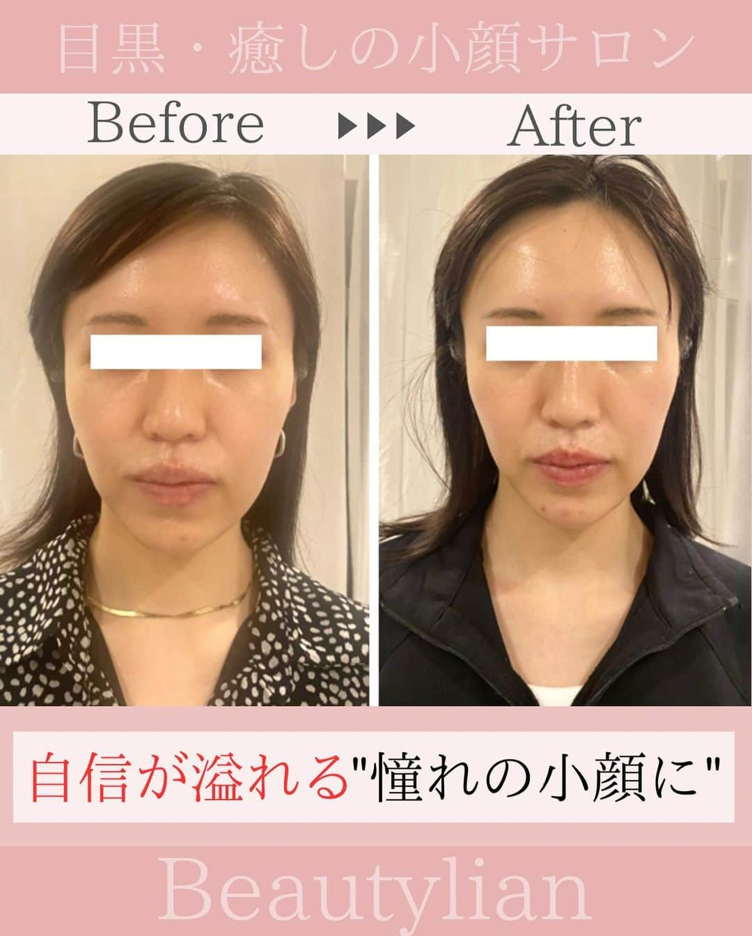 Eternal Total Beauty Salonのインスタグラム：「.  【自信が溢れる憧れの小顔に】  オーラはその人の内側から 現れるものであって その方の持ってる雰囲気だったり 真の強さだったり 愛だったりします。  人混みを歩いてる時に 目がいく人は 素敵なオーラを発してると思います。  やはり目がいく オーラを持ってる人の共通点は "自分の自信の現れ"です♡  小顔美人になるとオーラ美人にもなる✨  小顔美人になって 『美人オーラを出したい』 そんな方にも当サロンはおすすめです☺️ _  【小顔効果倍増なペース】 ＊初回から含めて3回目までは週1から空けても2週に1回のペースを推奨しております。 最初に土台を作り戻りにくく定着させる為です。 ⁡ ご新規様は3回分のご予約をオススメ致します。トップページのHPから承っております🙇‍♀️ ⁡ ⁡ ⁡ ＊＊＊＊＊＊＊＊＊＊＊＊＊＊＊＊＊＊＊＊ ⁡ ⁡ 小顔矯正/インディバ ⁡ ⁡ 営業時間　11:00〜20:00(18:30最終受付) ⁡ 定休日　不定休 ⁡ ⁡ ご予約はトップページのURLから🙇‍♀️✨ 【@beautylian_kogao】 ⁡ ＊＊＊＊＊＊＊＊＊＊＊＊＊＊＊＊＊＊＊＊ ⁡ #小顔矯正東京 #小顔矯正 #小顔矯正サロン  #かおやせ #小顔になりたい #リフトアップ #プレ花嫁東京 #花嫁美容 #小顔エステ  #たるみ解消 #目黒小顔 #リフトアップ効果  #顔の左右差 #目黒駅 #オーラ #自信をつけたい  #コンプレックス解消 #コンプレックスを自信に」