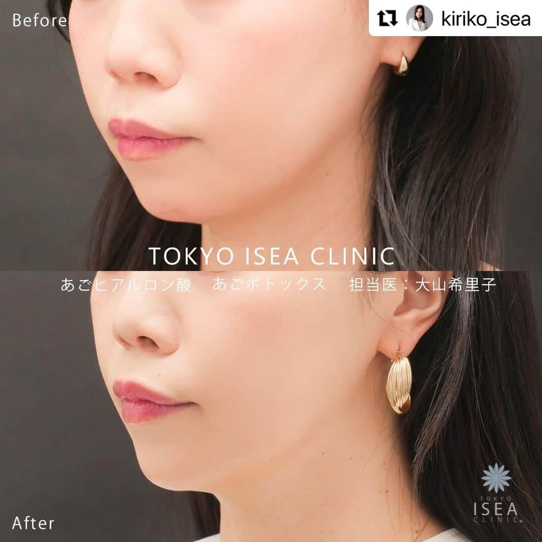のインスタグラム：「▶︎▷▶︎ 注入治療で輪郭形成 あごヒアルロン酸注入 　　　　＋ あごボトックス注入  ▼担当医 Dr.大山 希里子　@kiriko_isea   ▼詳細 💉あごヒアルロン酸  料金：¥132,000（税込）  💉あごボトックス 料金：¥33,000（税込 □イセアのオトクな注入プラン ・ちょい足しプラン 同部位のヒアルロン酸注射を通常料金の半額で受けることができます。  ・リピートプラン 前回の注入から６か月以内に注入すると、どの注入メニューでも10%OFFになるリピートチケットをプレゼントしています。  ・組み合わせプラン 注入治療を2つ以上組み合わせると10% OFFに♥  🏥リスク副作用 内出血や腫れやむくみ。  ----- ご予約・お問い合わせは プロフィール欄のURLからお願いします😊❤  #あご #顎 #顎ヒアルロン酸 #顎整形 #フェイスライン #フェイスラインがシャープに #シャープ #シェーディング」