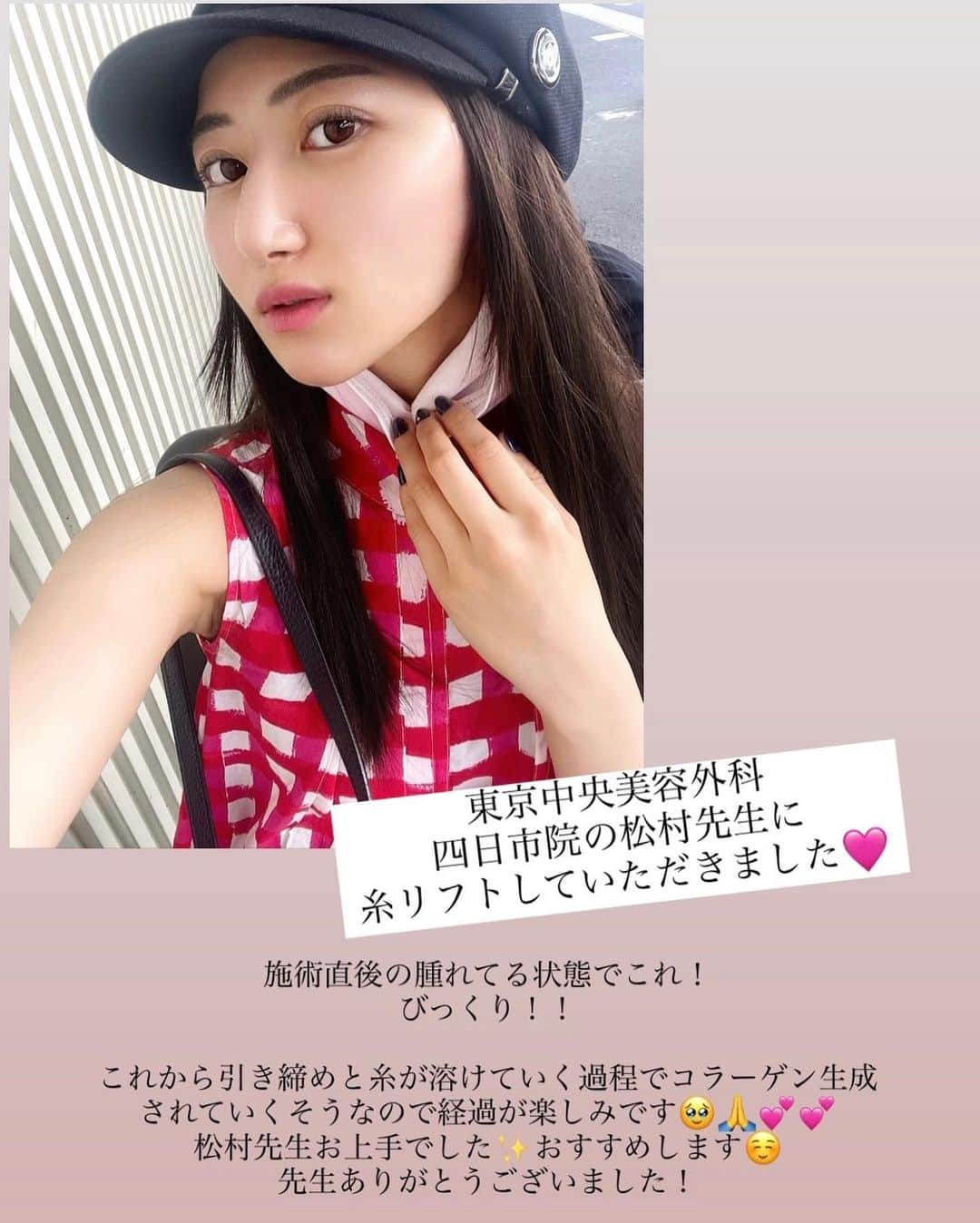 Manaさんのインスタグラム写真 - (ManaInstagram)「フェイスラインのアップデート🌷💕 ⁡ 東京中央美容外科四日市院 @tcb_yokkaichi の 松村先生👨🏻‍⚕️ @tcb_matsumura に TCB式小顔美肌再生をしていただきました！ ⁡ とても丁寧にカウンセリングしていただき 安心してお任せすることができました✨ ⁡ 松村先生はなんと 外科歴が10年以上あって施術がとってもお上手🥰 ベストな輪郭になるように調整してくださり 技術も素晴らしくておすすめしたい先生です☺️ ⁡ もともとフェイスラインはしゅっとしているほうで 周りからすればわかりにくい変化でも 自分にとっては大きな変化✨ ⁡ スタッフさんもみなさん暖かくて リラックスして施術を受けることができました♡ ⁡ 前にもTCB式小顔美肌再生を受けたことがあるけど、 糸が溶ける過程でコラーゲン生成されて 引き締めと共にお肌にも艶がでるよ😳 今回も経過が楽しみです💖 ⁡ ⁡ ⁡ ⁡ ⁡ ⁡ #東京中央美容外科 #TCB #TCB四日市院 #PR  #三重県 #美容外科 #美容皮膚科 #小顔 #小顔整形 #美肌 #二重あご #フェイスライン #糸リフト #顔痩せ #部分やせ #小顔になりたい #美意識 #tcb式小顔美肌再生」7月7日 18時30分 - mana.tcy