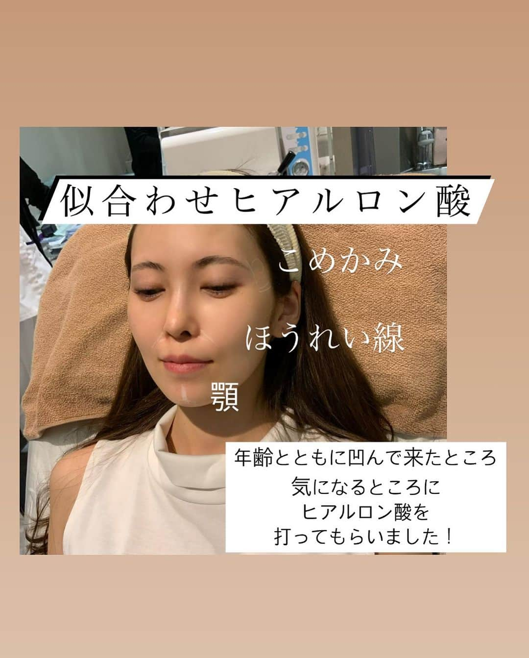 清水愛美さんのインスタグラム写真 - (清水愛美Instagram)「🦋  最近のアップデートを ご報告🫶💕  @venus_beauty_clinic  で 気になっていた箇所に ヒアルロン酸を打ってもらいました！ 似合わせヒアル💓  まず陥没していく コメカミと、鼻の横！ すこーしだけ顎にも入れて貰いました🫧 先生は @dr_tsubasa_sato 👏 少量なのにこんなに変わるとは！ やっぱり腕って大事だなって痛感。 ヒアルロン酸は 量を入れればいい訳じゃない😅  ヒアル顔にならない様に気をつけて 貰いました🥹💕ナチュラルに 可愛くなるのが大事👏  また相談しに行こー🥹💕💕 スネコスがまず気になってます👍  #美容 #美意識向上  #可愛くなりたい #venusbeautyclinic  #アップデート #美肌　#アンチエイジング  #老化防止　#男の子ママ」7月10日 19時00分 - manami_s0902