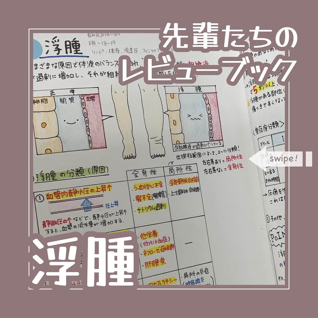 ネコナースのインスタグラム：「今回紹介する先輩（@lemon_nurse_study)は、浮腫についてカラフルにかわいくまとめてくれています。   浮腫は実習でよく遭遇する身体症状の一つです❕ 浮腫になる原因はさまざまありますので、患者さんの病態や疾患などから原因を明らかにしてみましょう✨  評価方法やアセスメントのポイントなどの知識をまとめておくと、看護師になった際にすぐに実践で活かせそうですね❕💚   『レビューブック2023-24』医-18辺りにまとめて、貼り付けてみてください⭐️  #レビューブック #先輩たちのレビューブック #マイレビューブック #レビューブック太っちょ計画 #第113回看護師国家試験 #浮腫 #評価 #看護学生の勉強垢 #看護学生さんと仲良くなりたい #メディックメディア」