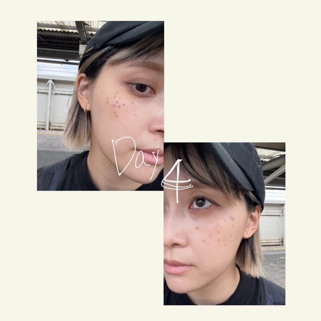 和田えりかさんのインスタグラム写真 - (和田えりかInstagram)「PQXピコレーザーの経過 (参考になれば◯)  ピコレーザーやる時はぜったい 帽子持って行った方がいいよ！！！ (深くかぶれるやつね)  てかね、気になってたシミが消えたよ、うれしい、、 少しダウンタイムあるけど わたしは全く気にしないで外歩いてたし、、韓国に行っていたよ~🕴🏻🫶🏻 ※日焼けだけは要注意⚠️  1週間で黒ポチが取れた、、 (洗顔しているときに) 個人差はあるとおもうが、、、！  クリニックは、、 @tokyo_hills_clinic  杉浦先生だよ🫡(神さまともいう  糸リフトもボトックスもぜーんぶ 東京ヒルズクリニックー！ 糸リフトの経過をリールで 作ってるから待ってて！💬👶🏻  ちなみに先生に二の腕の脂肪も 相談してみようかな〜って思ってるよ📞👊🏻  もっともっと肌きれいになりたいし かわいくなりたぁい、、、、、  がんばろ、、！  #ピコレーザー#経過」7月12日 23時59分 - _wadaerika