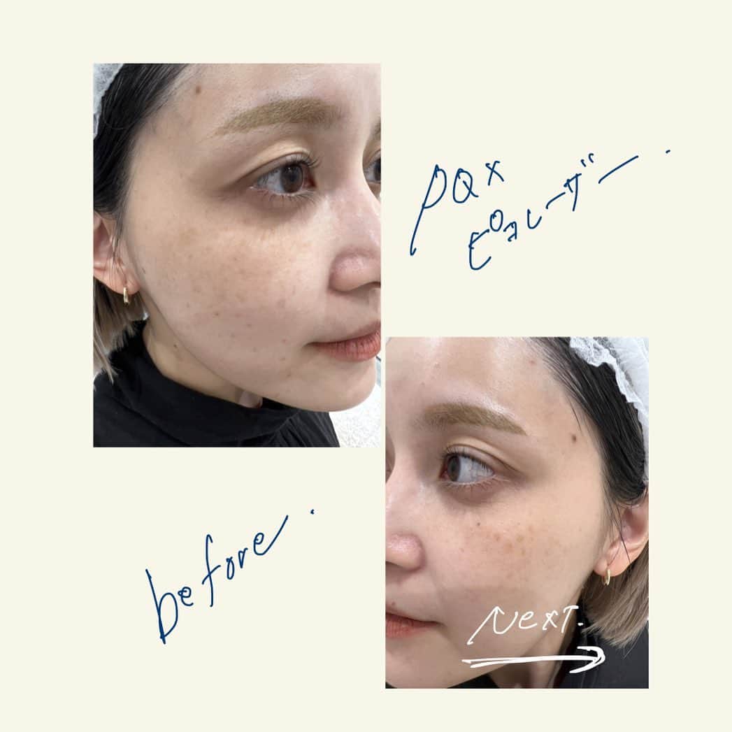 和田えりかさんのインスタグラム写真 - (和田えりかInstagram)「PQXピコレーザーの経過 (参考になれば◯)  ピコレーザーやる時はぜったい 帽子持って行った方がいいよ！！！ (深くかぶれるやつね)  てかね、気になってたシミが消えたよ、うれしい、、 少しダウンタイムあるけど わたしは全く気にしないで外歩いてたし、、韓国に行っていたよ~🕴🏻🫶🏻 ※日焼けだけは要注意⚠️  1週間で黒ポチが取れた、、 (洗顔しているときに) 個人差はあるとおもうが、、、！  クリニックは、、 @tokyo_hills_clinic  杉浦先生だよ🫡(神さまともいう  糸リフトもボトックスもぜーんぶ 東京ヒルズクリニックー！ 糸リフトの経過をリールで 作ってるから待ってて！💬👶🏻  ちなみに先生に二の腕の脂肪も 相談してみようかな〜って思ってるよ📞👊🏻  もっともっと肌きれいになりたいし かわいくなりたぁい、、、、、  がんばろ、、！  #ピコレーザー#経過」7月12日 23時59分 - _wadaerika