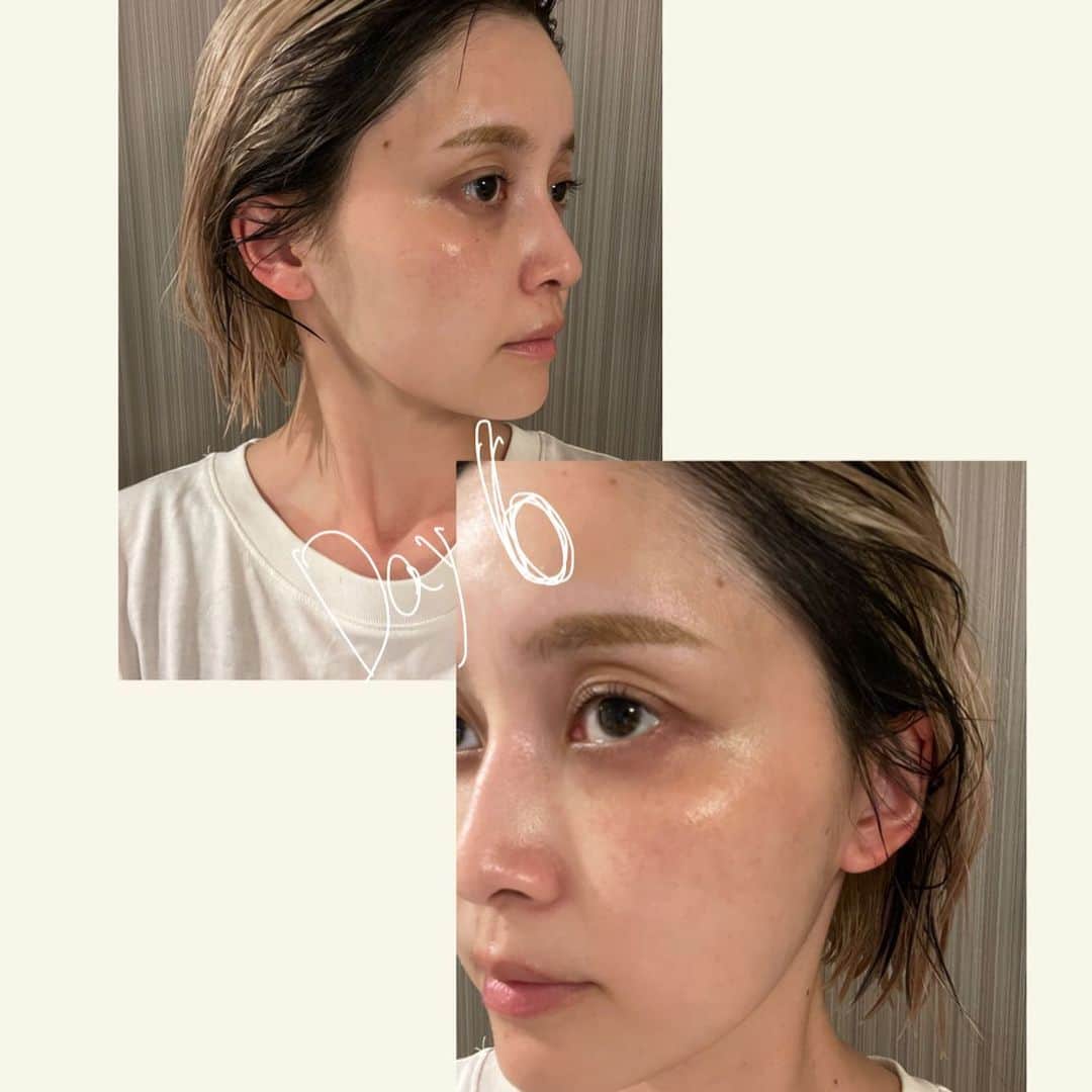 和田えりかさんのインスタグラム写真 - (和田えりかInstagram)「PQXピコレーザーの経過 (参考になれば◯)  ピコレーザーやる時はぜったい 帽子持って行った方がいいよ！！！ (深くかぶれるやつね)  てかね、気になってたシミが消えたよ、うれしい、、 少しダウンタイムあるけど わたしは全く気にしないで外歩いてたし、、韓国に行っていたよ~🕴🏻🫶🏻 ※日焼けだけは要注意⚠️  1週間で黒ポチが取れた、、 (洗顔しているときに) 個人差はあるとおもうが、、、！  クリニックは、、 @tokyo_hills_clinic  杉浦先生だよ🫡(神さまともいう  糸リフトもボトックスもぜーんぶ 東京ヒルズクリニックー！ 糸リフトの経過をリールで 作ってるから待ってて！💬👶🏻  ちなみに先生に二の腕の脂肪も 相談してみようかな〜って思ってるよ📞👊🏻  もっともっと肌きれいになりたいし かわいくなりたぁい、、、、、  がんばろ、、！  #ピコレーザー#経過」7月12日 23時59分 - _wadaerika