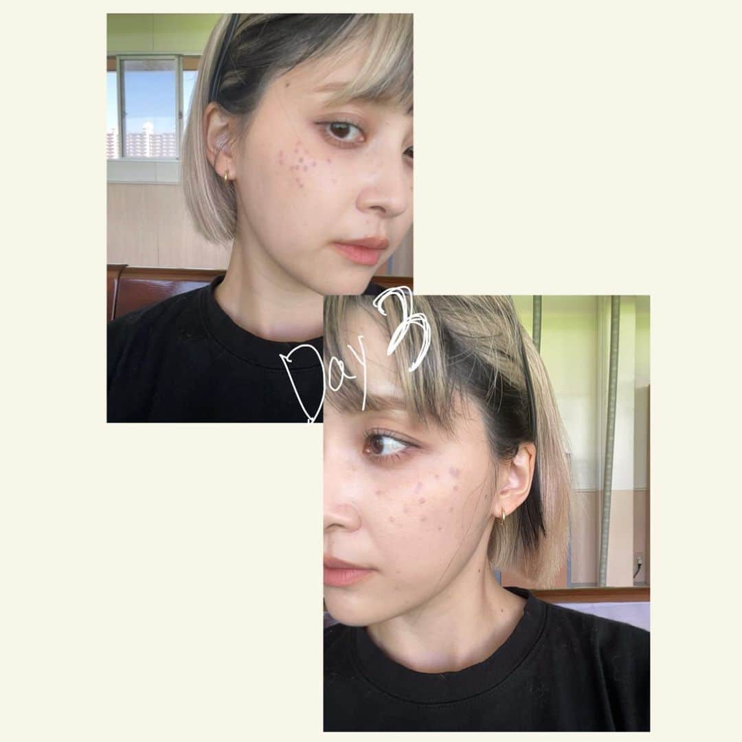 和田えりかさんのインスタグラム写真 - (和田えりかInstagram)「PQXピコレーザーの経過 (参考になれば◯)  ピコレーザーやる時はぜったい 帽子持って行った方がいいよ！！！ (深くかぶれるやつね)  てかね、気になってたシミが消えたよ、うれしい、、 少しダウンタイムあるけど わたしは全く気にしないで外歩いてたし、、韓国に行っていたよ~🕴🏻🫶🏻 ※日焼けだけは要注意⚠️  1週間で黒ポチが取れた、、 (洗顔しているときに) 個人差はあるとおもうが、、、！  クリニックは、、 @tokyo_hills_clinic  杉浦先生だよ🫡(神さまともいう  糸リフトもボトックスもぜーんぶ 東京ヒルズクリニックー！ 糸リフトの経過をリールで 作ってるから待ってて！💬👶🏻  ちなみに先生に二の腕の脂肪も 相談してみようかな〜って思ってるよ📞👊🏻  もっともっと肌きれいになりたいし かわいくなりたぁい、、、、、  がんばろ、、！  #ピコレーザー#経過」7月12日 23時59分 - _wadaerika