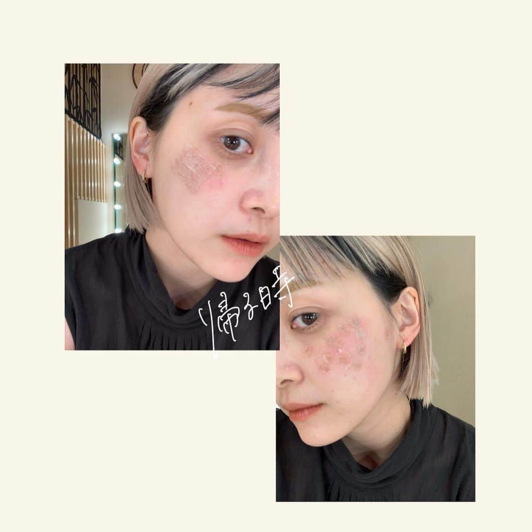 和田えりかさんのインスタグラム写真 - (和田えりかInstagram)「PQXピコレーザーの経過 (参考になれば◯)  ピコレーザーやる時はぜったい 帽子持って行った方がいいよ！！！ (深くかぶれるやつね)  てかね、気になってたシミが消えたよ、うれしい、、 少しダウンタイムあるけど わたしは全く気にしないで外歩いてたし、、韓国に行っていたよ~🕴🏻🫶🏻 ※日焼けだけは要注意⚠️  1週間で黒ポチが取れた、、 (洗顔しているときに) 個人差はあるとおもうが、、、！  クリニックは、、 @tokyo_hills_clinic  杉浦先生だよ🫡(神さまともいう  糸リフトもボトックスもぜーんぶ 東京ヒルズクリニックー！ 糸リフトの経過をリールで 作ってるから待ってて！💬👶🏻  ちなみに先生に二の腕の脂肪も 相談してみようかな〜って思ってるよ📞👊🏻  もっともっと肌きれいになりたいし かわいくなりたぁい、、、、、  がんばろ、、！  #ピコレーザー#経過」7月12日 23時59分 - _wadaerika