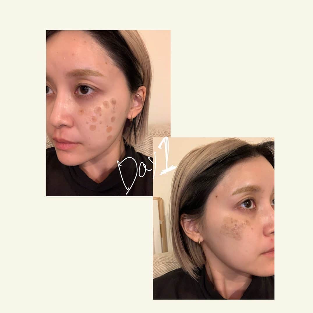 和田えりかさんのインスタグラム写真 - (和田えりかInstagram)「PQXピコレーザーの経過 (参考になれば◯)  ピコレーザーやる時はぜったい 帽子持って行った方がいいよ！！！ (深くかぶれるやつね)  てかね、気になってたシミが消えたよ、うれしい、、 少しダウンタイムあるけど わたしは全く気にしないで外歩いてたし、、韓国に行っていたよ~🕴🏻🫶🏻 ※日焼けだけは要注意⚠️  1週間で黒ポチが取れた、、 (洗顔しているときに) 個人差はあるとおもうが、、、！  クリニックは、、 @tokyo_hills_clinic  杉浦先生だよ🫡(神さまともいう  糸リフトもボトックスもぜーんぶ 東京ヒルズクリニックー！ 糸リフトの経過をリールで 作ってるから待ってて！💬👶🏻  ちなみに先生に二の腕の脂肪も 相談してみようかな〜って思ってるよ📞👊🏻  もっともっと肌きれいになりたいし かわいくなりたぁい、、、、、  がんばろ、、！  #ピコレーザー#経過」7月12日 23時59分 - _wadaerika