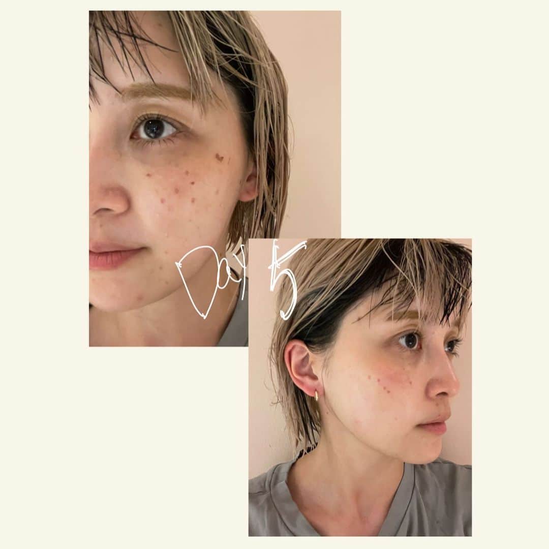 和田えりかさんのインスタグラム写真 - (和田えりかInstagram)「PQXピコレーザーの経過 (参考になれば◯)  ピコレーザーやる時はぜったい 帽子持って行った方がいいよ！！！ (深くかぶれるやつね)  てかね、気になってたシミが消えたよ、うれしい、、 少しダウンタイムあるけど わたしは全く気にしないで外歩いてたし、、韓国に行っていたよ~🕴🏻🫶🏻 ※日焼けだけは要注意⚠️  1週間で黒ポチが取れた、、 (洗顔しているときに) 個人差はあるとおもうが、、、！  クリニックは、、 @tokyo_hills_clinic  杉浦先生だよ🫡(神さまともいう  糸リフトもボトックスもぜーんぶ 東京ヒルズクリニックー！ 糸リフトの経過をリールで 作ってるから待ってて！💬👶🏻  ちなみに先生に二の腕の脂肪も 相談してみようかな〜って思ってるよ📞👊🏻  もっともっと肌きれいになりたいし かわいくなりたぁい、、、、、  がんばろ、、！  #ピコレーザー#経過」7月12日 23時59分 - _wadaerika