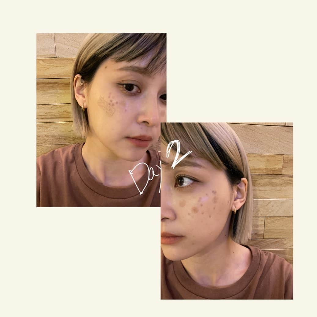 和田えりかさんのインスタグラム写真 - (和田えりかInstagram)「PQXピコレーザーの経過 (参考になれば◯)  ピコレーザーやる時はぜったい 帽子持って行った方がいいよ！！！ (深くかぶれるやつね)  てかね、気になってたシミが消えたよ、うれしい、、 少しダウンタイムあるけど わたしは全く気にしないで外歩いてたし、、韓国に行っていたよ~🕴🏻🫶🏻 ※日焼けだけは要注意⚠️  1週間で黒ポチが取れた、、 (洗顔しているときに) 個人差はあるとおもうが、、、！  クリニックは、、 @tokyo_hills_clinic  杉浦先生だよ🫡(神さまともいう  糸リフトもボトックスもぜーんぶ 東京ヒルズクリニックー！ 糸リフトの経過をリールで 作ってるから待ってて！💬👶🏻  ちなみに先生に二の腕の脂肪も 相談してみようかな〜って思ってるよ📞👊🏻  もっともっと肌きれいになりたいし かわいくなりたぁい、、、、、  がんばろ、、！  #ピコレーザー#経過」7月12日 23時59分 - _wadaerika