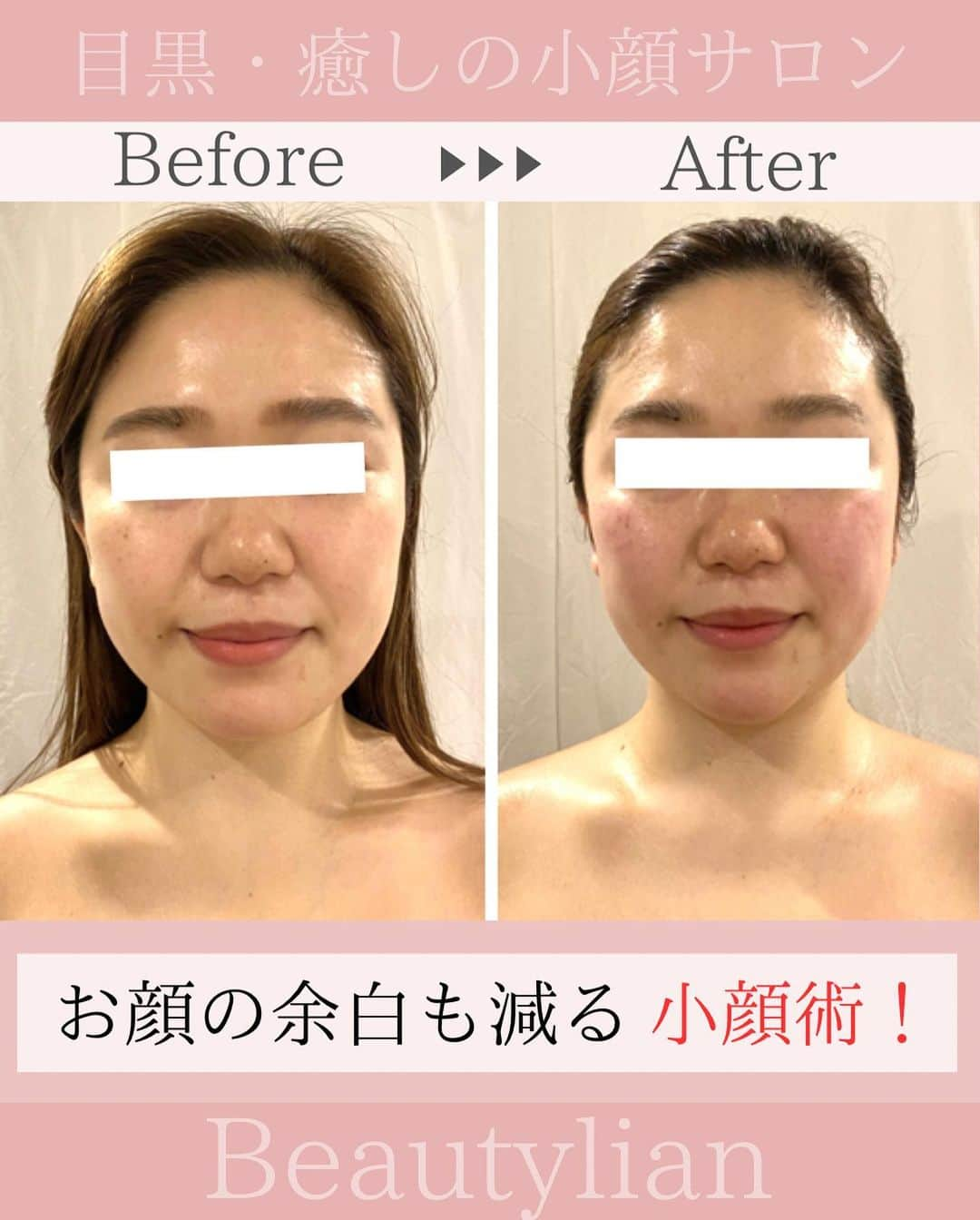 Eternal Total Beauty Salonのインスタグラム：「.  【お顔の余白も減る小顔術！】  お顔の余白の正体は 老廃物や水分、脂肪の蓄積によるもの。  年齢と共に代謝が落ちて 血液やリンパの流れが悪くなり、 これらを溜め込むと フェイスラインや頬などに ゆるみやむくみ、もたつきなどが 現れてしまいます。  施術６回目のお客様☺️ お顔の余白が減り 周りから痩せてみられるように◎  また小顔になるだけではなく、  ◎胸が開き姿勢が良くなる ◎目の高さが揃う  このような効果もございます♡  【小顔効果倍増なペース】 ＊初回から含めて3回目までは週1から空けても2週に1回のペースを推奨しております。 最初に土台を作り戻りにくく定着させる為です。 ⁡ ご新規様は3回分のご予約をオススメ致します。トップページのHPから承っております🙇‍♀️ ⁡ ⁡ ⁡ ＊＊＊＊＊＊＊＊＊＊＊＊＊＊＊＊＊＊＊＊ ⁡ ⁡ 小顔矯正/インディバ ⁡ ⁡ 営業時間　11:00〜20:00(18:30最終受付) ⁡ 定休日　不定休 ⁡ ⁡ ご予約はトップページのURLから🙇‍♀️✨ 【 @kogao_beautylian 】 ⁡ ＊＊＊＊＊＊＊＊＊＊＊＊＊＊＊＊＊＊＊＊ ⁡ #小顔矯正東京 #小顔矯正 #小顔矯正サロン  #かおやせ #小顔になりたい #リフトアップ #プレ花嫁東京 #花嫁美容 #小顔エステ  #たるみ解消 #目黒小顔 #リフトアップ効果  #目黒駅 #若返り効果 #垢抜け #姿勢美人  #顔痩せ効果#小顔矯正ビューティーリアン」