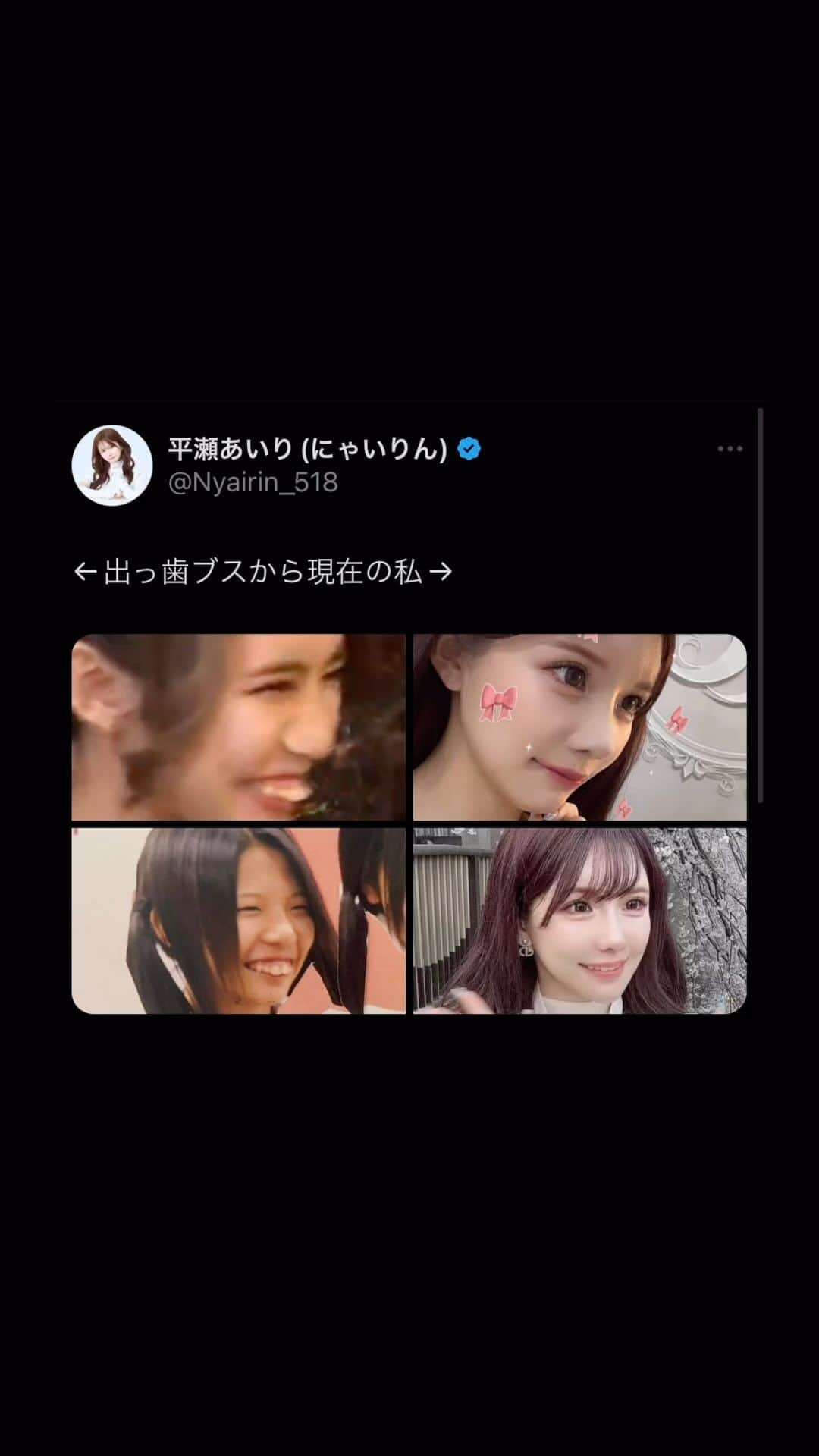 にゃいりんのインスタグラム：「←出っ歯ブスから現在の私→ #ツイッター #確定 #おもしろ #ツイート #平瀬あいり  #にゃいりん #tiktok」