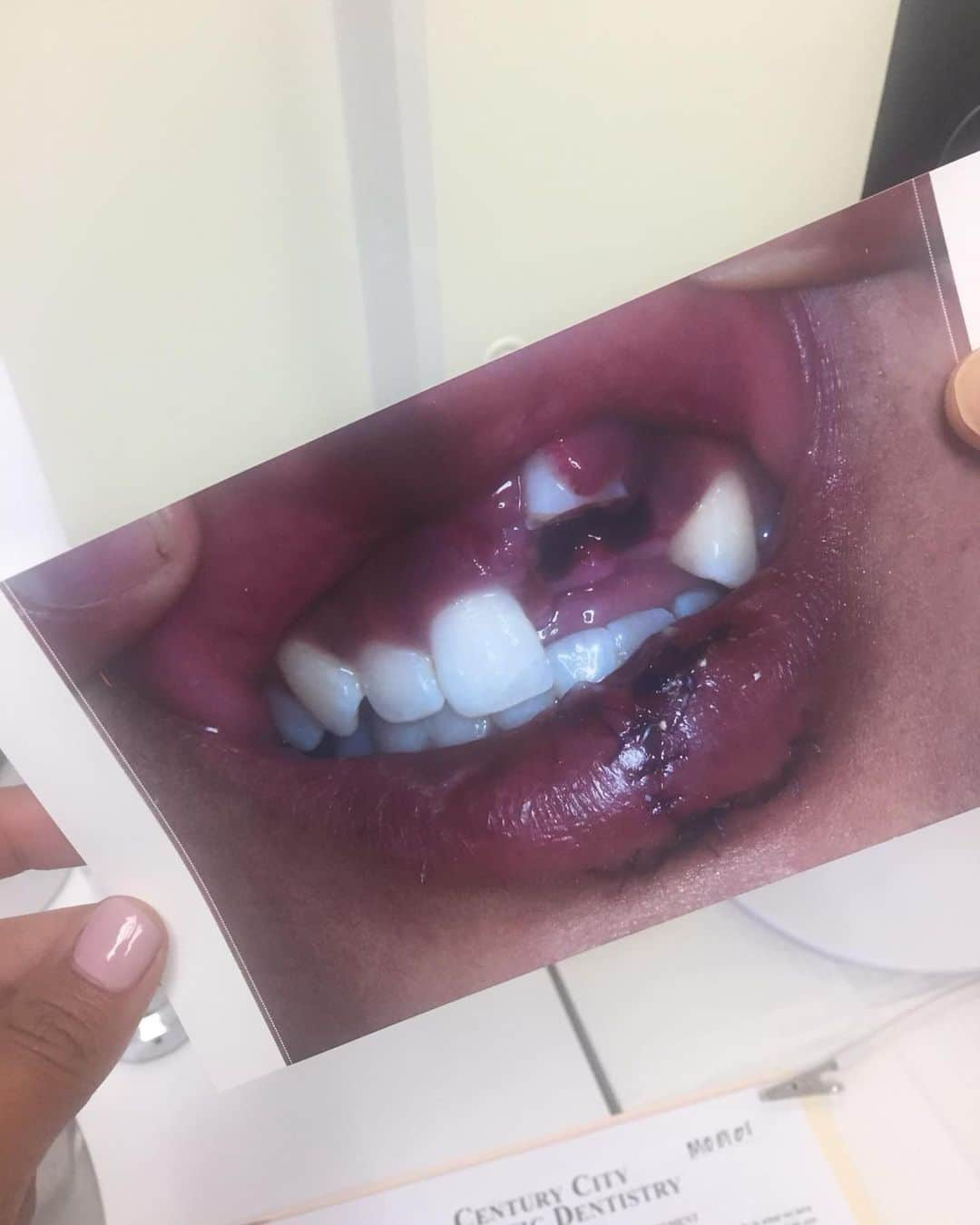 ケリア・モニーツさんのインスタグラム写真 - (ケリア・モニーツInstagram)「HOW IT STARTED vs. HOW ITS GOING. 7 years later. I couldn’t be more thankful for the @drokuda Dental Practice. There is so much to say about his work, his service, and his genuine care for his patients. The first picture is an hour after I face planted on a boat in the Maldives. Second pic is about a week after the accident. Third is my smile today thanks to the care, talent, and ever evolving education and technology that goes into Dr. Okuda’s practice. His practice is a one stop shop. He performs the surgery, the reconstruction of bone & gum (which many cosmetic dentists, especially ones at his level, do not offer), and of course the beautiful artistry of the final veneer. I destroyed not only my bone, but my gum line. Something I learned only from experience is that our gums are so sensitive, and extremely hard to reconstruct. He has now done 3 gum line restorations for me. Because of the bone damage, my gum line will probably move around for the rest of my life, but I’m ok with that cause I know I’m under the best care. Losing your front teeth is like being stripped of your literal identity. It was scary, sad,  and created insecurities! But he gave me my smile back!!! Thank you Doctor, not only for what you do, but for how you care. So if you or anyone you know is in need of intense dental care, please see him! Your smile is worth it!」7月16日 8時36分 - keliamoniz