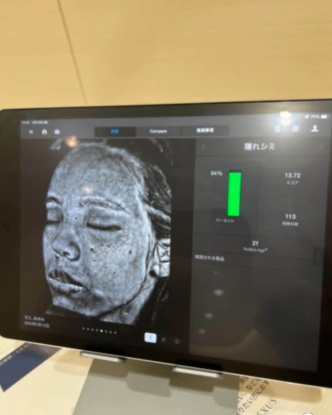 瀬戸あゆみさんのインスタグラム写真 - (瀬戸あゆみInstagram)「お待たせしました！ @nexus_clinic で行った、シミ取りのピコスポットのレポート。  1枚目が現在です。 コンシーラーがいらなくなりました。。！うれしい✨✨  2枚目と3枚目が、クリニックの様子。 めちゃおしゃれでどぎまぎ。💚🌿  4枚目が、施術直後です。 ちょっとだけ痛かった🥹けど、看護師さん優しくて乗り切れました❣️(日焼け対策の質問攻めもした)  5枚目は、経過。日付を見たら、4日後でした。 ちょっと残ってるかな？という感じ。  6枚目は、施術前の、悩んでいる時です。 これ、写真を見直すとわかるけど、ファンデーション＋コンシーラー塗ってるのに、浮き出てますね。。。  7枚目は、ネクサスに最初に行くとやってもらえる、肌の状態をいろいろ見てもらったとき。 同時に顔全体にピコレーザーもしてもらって、隠れしみに対してのアプローチもしてもらいました！  ここにでている数値が高ければ高いほどいいらしく、しみは97%で、隠れしみも94%と、しみで悩んで行った割に、数値はかなりよかった。。！ でしたので、この日は別の箇所の施術もしてもらってきました。。🥰  その話は、次回の #ayumi_recommendation で🌷 夏、毎日日差しが強いけど、せっかくコンプレックスがひとつなくなったし、日焼け対策頑張るぞ😤  #nexusclinic #ピコスポット #ピコレーザー」7月16日 12時11分 - setoayumi
