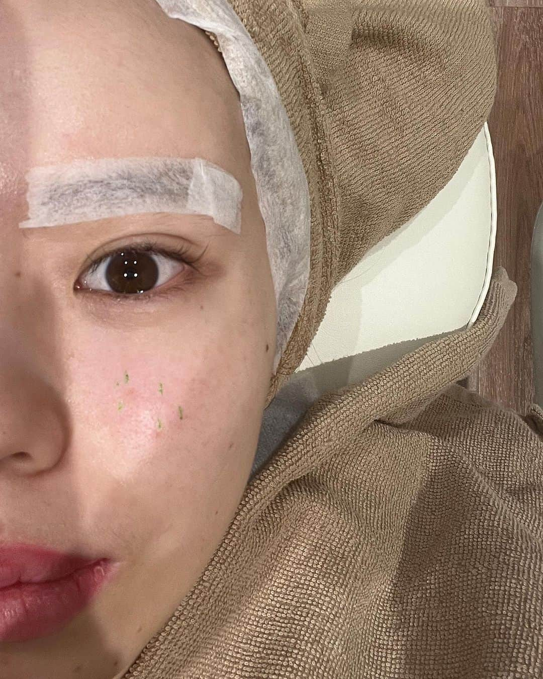 瀬戸あゆみさんのインスタグラム写真 - (瀬戸あゆみInstagram)「お待たせしました！ @nexus_clinic で行った、シミ取りのピコスポットのレポート。  1枚目が現在です。 コンシーラーがいらなくなりました。。！うれしい✨✨  2枚目と3枚目が、クリニックの様子。 めちゃおしゃれでどぎまぎ。💚🌿  4枚目が、施術直後です。 ちょっとだけ痛かった🥹けど、看護師さん優しくて乗り切れました❣️(日焼け対策の質問攻めもした)  5枚目は、経過。日付を見たら、4日後でした。 ちょっと残ってるかな？という感じ。  6枚目は、施術前の、悩んでいる時です。 これ、写真を見直すとわかるけど、ファンデーション＋コンシーラー塗ってるのに、浮き出てますね。。。  7枚目は、ネクサスに最初に行くとやってもらえる、肌の状態をいろいろ見てもらったとき。 同時に顔全体にピコレーザーもしてもらって、隠れしみに対してのアプローチもしてもらいました！  ここにでている数値が高ければ高いほどいいらしく、しみは97%で、隠れしみも94%と、しみで悩んで行った割に、数値はかなりよかった。。！ でしたので、この日は別の箇所の施術もしてもらってきました。。🥰  その話は、次回の #ayumi_recommendation で🌷 夏、毎日日差しが強いけど、せっかくコンプレックスがひとつなくなったし、日焼け対策頑張るぞ😤  #nexusclinic #ピコスポット #ピコレーザー」7月16日 12時11分 - setoayumi