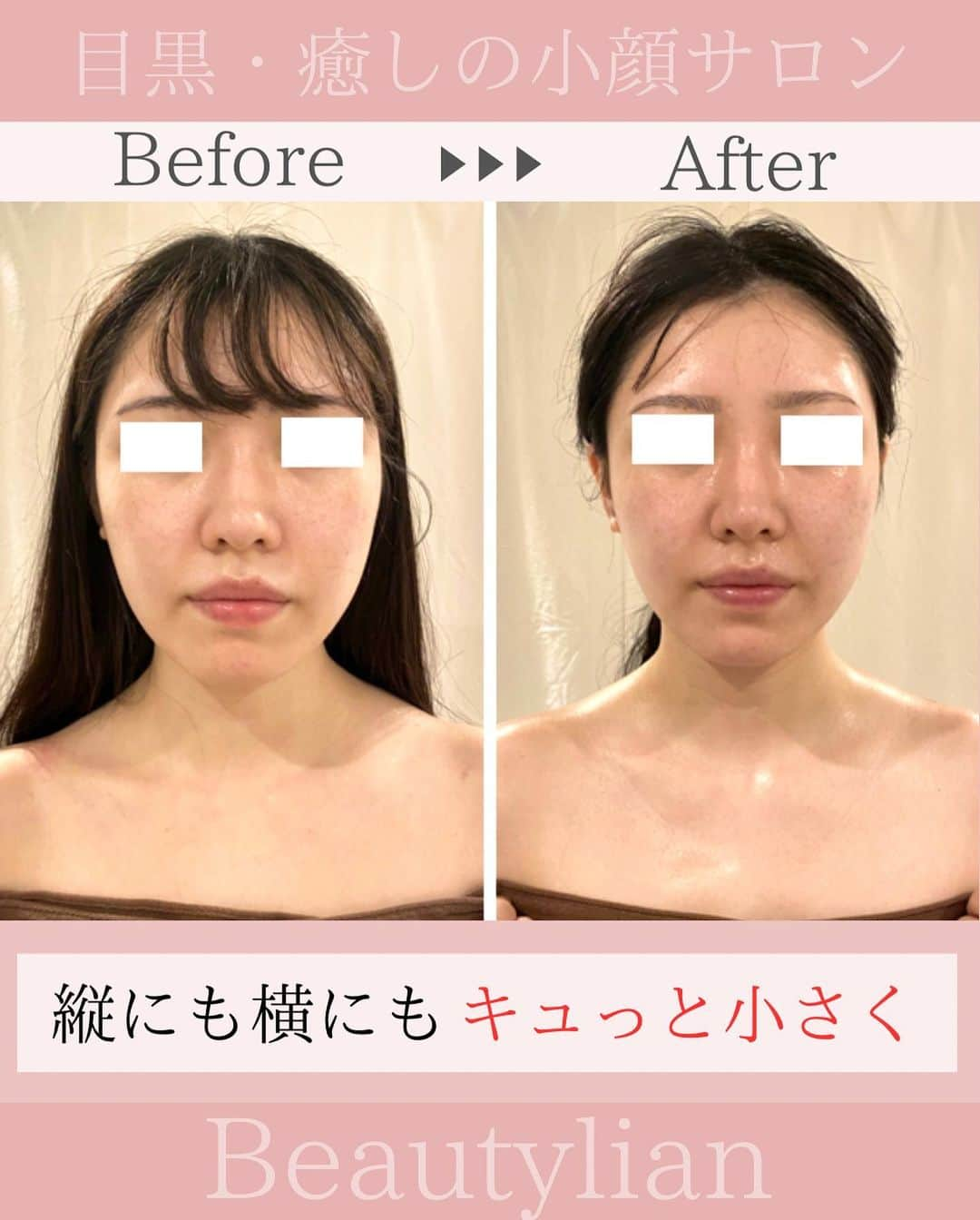 Eternal Total Beauty Salonのインスタグラム：「【眠っている間にお顔が変わる！】⁣ ⁣ ⁣ 当店の小顔矯正は最初から最後まで⁣痛みゼロです🕊⁣ ⁣ ⁣ 触るのはお顔だけではなく⁣ ヘッド、首肩、デコルテケアも入ります⁣ ⁣ ⁣ ⁣ お顔は触りすぎるとたるみに 繋がってしまうので10分、 長くても15分程度しか⁣触りません😌⁣  ⁣ お顔を変えるだけではなくて⁣ サロンに来てくだっている 時間は⁣身も心も解放して　 1ヶ月の疲れをリセットして  今より自分のお顔が好きになり 「また明日から頑張ろう！」 って活力になってもらえると嬉しいです✨  _  【小顔効果倍増なペース】 ＊初回から含めて3回目までは週1から空けても2週に1回のペースを推奨しております。 最初に土台を作り戻りにくく定着させる為です。 ⁡ ご新規様は3回分のご予約をオススメ致します。トップページのHPから承っております🙇‍♀️ ⁡ ⁡ ⁡ ＊＊＊＊＊＊＊＊＊＊＊＊＊＊＊＊＊＊＊＊ ⁡ ⁡ 小顔矯正/インディバ ⁡ ⁡ 営業時間　11:00〜20:00(18:30最終受付) ⁡ 定休日　不定休 ⁡ ⁡ ご予約はトップページのURLから🙇‍♀️✨ 【　@kogao_beautylian 】 ⁡ ＊＊＊＊＊＊＊＊＊＊＊＊＊＊＊＊＊＊＊＊ ⁡ #小顔矯正東京 #小顔矯正 #小顔矯正サロン  #かおやせ #小顔になりたい #リフトアップ #プレ花嫁東京 #花嫁美容 #小顔エステ  #たるみ解消 #目黒小顔 #リフトアップ効果  #目黒駅 #若返り効果 #垢抜け #姿勢美人  #顔の余白  #顔痩せ効果 #小顔矯正ビューティーリアン」