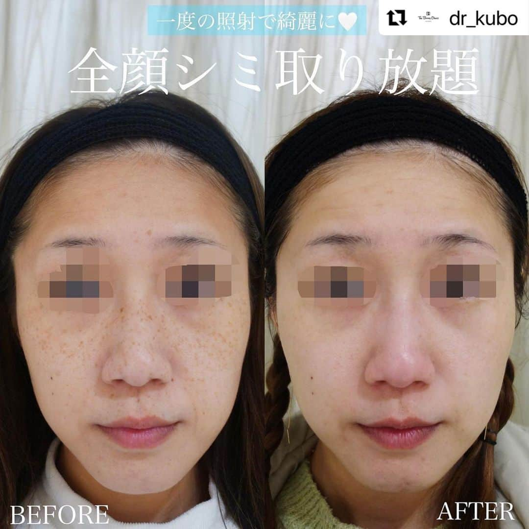 YAG BEAUTY CLINICさんのインスタグラム写真 - (YAG BEAUTY CLINICInstagram)「#Repost @dr_kubo with @use.repost ・・・ . シミ取り ＿＿＿＿＿＿＿＿＿＿＿＿＿＿＿＿＿＿＿＿＿＿＿＿＿＿ 施術：SPOT照射、トラネキサム酸内服 リスク：色素沈着、肝斑の増悪、取りきれない、色むら、白抜けなど 写真：照射前、照射後2ヶ月後 ￣￣￣￣￣￣￣￣￣￣￣￣￣￣￣￣￣￣￣￣￣￣￣￣￣￣  そばかすの方です。額は肝斑があります。  そばかすに対しSPOT照射を行い、綺麗にしました🤍  この方は何の問題もなく経過しましたが、SPOT照射のリスクとして色素沈着、取りきれない、肝斑の増悪の可能性があります。  費用　全顔98,000円(モニター69,800円) 　　　鼻頬のみ59,800円  #肝斑#シミ取り#シミ取りレーザー#レーザートーニング#シミ取り放題#thebeautyclinic」8月12日 15時03分 - yagbeauty_official