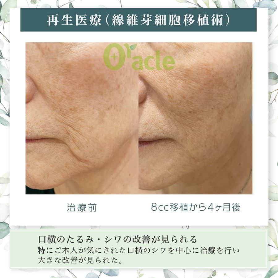 オラクル美容皮膚科東京新宿院のインスタグラム：「◤ 肌の再生医療（セルバンク） ◢| ※当院の再生医療は北條元治先生の自家培養真皮線維芽細胞移植です。  🩺現在は新宿院の古市統括院長のみ再生医療を担当しております。  《治療内容》 8CC 移植 ※移植回数は4CC×2回 ※一番気にされていた口横のたるみジワを中心に治療し、大きく改善 ☞モニターさんも大変満足されて喜んでいただきました。  気になる箇所は手打ちで、お顔全体は機械で移植します。  《治療内容の詳細》 日焼けなどのダメージの少ない耳の裏から皮膚を採取し、（米粒～小さじ一杯分程度の大きさ） その皮膚から細胞を取り出し専用の施設で培養し10,000倍に細胞の数を増やし 増やした細胞をもう一度お肌に戻す再生医療です。 細胞が増えることでお肌にハリや潤いを与えお肌全体を若返らせる治療です。  ⚠️副作用・リスク等 ご自身の細胞のため副作用は極めて低いですが 一般的な医療行為と同じように内出血、色素沈着の可能性があります。  【料金】 セルバンクの初診料​	5,500円 血液検査​	11,000円 細胞採取・培養	　495,000円 初回移植1回目（1ccの場合）	151,800円 初回移植2回目（1ccの場合）	151,800円  【移植料金】 1cc 151,800円 2cc 303,600円 3cc 455,400円 4cc 607,200円  上記の他、細胞を保管する場合 細胞保管料：11,000円／月  🉐モニタープラン（Aプラン、Bプラン、Cプラン）のご用意もございます。  詳しくはオラクル美容皮膚科公式サイトにてご確認お願い致します。  #再生医療 #肌の再生医療 #セルバンク #北條先生　#北條元治  #若返り #アンチエイジング #ほうれい線 #たるみ」