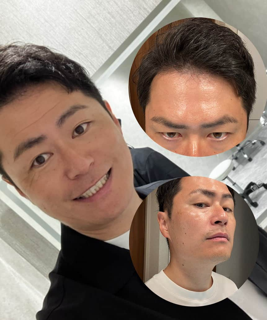 梅村賢太郎のインスタグラム：「おでこのしわと顔のたるみを診てもらいました！ 施術は一瞬で終わり。痛みほぼなし。 デコピンが5やとしたら1くらいの痛さ。 ただ、僕が痛みに強いらしく「ほんまに注射してますか？」と南先生に聞いたら「してるわ！」とツッコミ。 すんません 笑 施術前のカウンセリングはたっぷり。 スタッフさんも施術してる方が多く、体験談後日談聞けるので、安心。みんな綺麗。飲み行きたい。 後輩の奥さんの友達やった。 いらんこと言わんでよかった。 カウンセリングルームにお手洗いがあって、センサー良すぎて便座がずっとパカパカします 彼の「ウィーン」で緊張が解れます 全部最新でした  1週間経ってこんな感じ 1ヶ月後また投稿します！  #マイプレイスビューティークリニック #マイプレイス #myplacebeautyclinic #美容外科 #美容皮膚科 #美容整形外科 #プチ整形 #形成外科専門医 #南享介 #八木優 #大阪 #心斎橋 #ヒアルロン酸注入 #ボトックス #ボトックス注射 #心斎橋クリニック  マイプレイス @myplacebeautyclinic 南先生 @minamibiyogeka 八木先生 @dr.yu_yagi_dermatology」