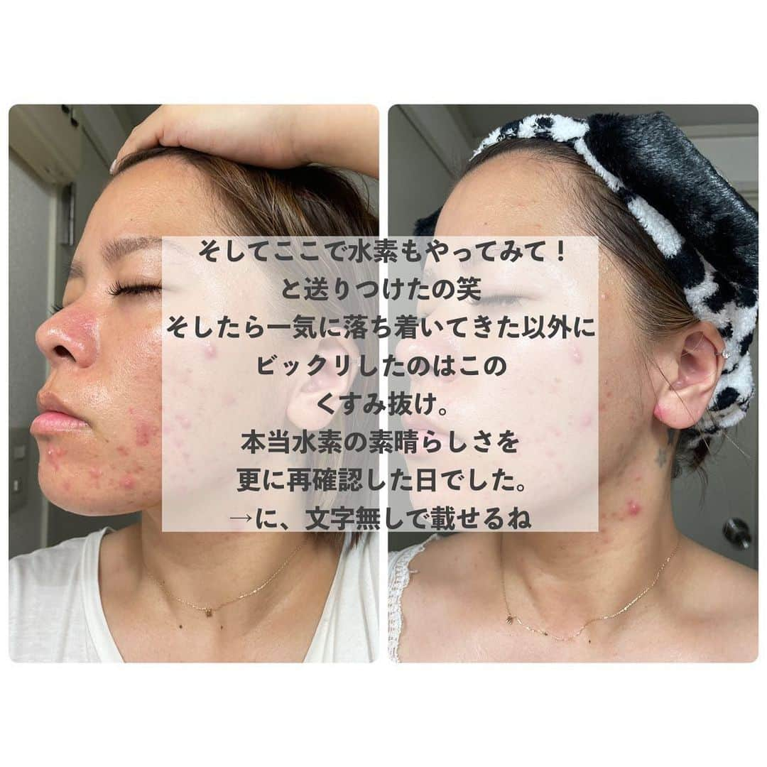 Arisaさんのインスタグラム写真 - (ArisaInstagram)「【私の友達のリアルな肌日記📔※ニキビ肌写真あり】  初めて会ったのはコロナ前。 彼女は全然肌荒れもしてなく綺麗な肌だったんだけど、この間久しぶりに会ったら痛そうなニキビを沢山抱えてて🥲 どーにかこーにかスキンケア会社をやってる私がしてあげたくて、 食生活とか色々アドバイスをしたんだけど、良くならなくてね、、、 本人が1番気をつけてるの分かってるから、それなのに肌が良くならなくてストレスだろうなぁと思ってたんだよね😩  そんなある日彼女が私のストーリーみて、私買う！VITADROP使ってみる！って飛び込んでくれて😢😢😢💛  それからのストーリーがこの画像なんです🥹🙏  前にトゥルースドロップもまつ毛美容液もと色々試してくれていたんだけど、続ける事が難しくまた絶対使いたい！！って言ってくれてたトゥルースドロップもまた再開してくれてて🥲  私は何より彼女の心を救えたのがほんっとうに嬉しくてね🥲 身近なお友達をこうして助けられるのって本当素敵な事だなぁと思いました🥲🥲🥲きっとね、私の友達で私に報告してなく使ってくれてる子沢山居るんだよね。 本当嬉しい🥲  顧客様のピースラバーの皆様の中でもきっとこうして手助け出来てる人が少なからずとも居るんだと思うと、本当このお仕事をしていて良かったと心から思えます😢💛  この場を借りて本当にありがとうございます。 そして試してくれたけど、肌に合わずむしろ荒れてしまったという方も勿論いらっしゃると思います。 その方達には本当謝罪する事しか出来ず申し訳ございませんが、本当に悔しくてならないです🙇‍♀️ 一歩を踏み出して下さりありがとうございます😭  この投稿もまた誰かの励みや力になると信じて本人に了承を得て投稿させて頂きました。  TJC→トゥルースジュレクレンズ（クレンジング） TSW→トゥルースシルクウォッシュ（洗顔） VD→ビタドロップ（ビタミンC美容液） TD→トゥルースドロップ（保湿美容液） FRP→エフリムーバルパック（水素パック）  @peaceofshine   #美肌への道のり」8月13日 10時55分 - saarariii