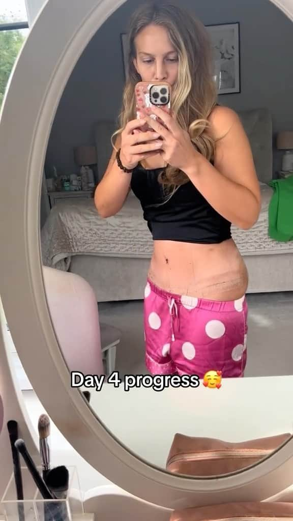 Anna Sacconeのインスタグラム：「Days 1-5 of my #mommymakeoverjourney ✨🩷🙏🏼 #plasticsurgery #mommymakeover #mommymakeoversurgery #tummytuckbeforeandafter #tummytuck #breastlift #lipofilling #liposuction #momof4 #mumof4 #4kidsmama #sacconejolys」