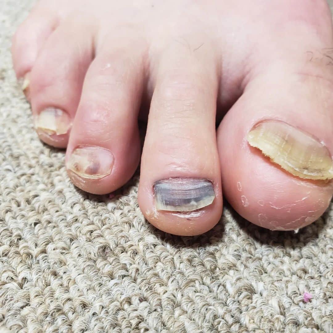 鏑木毅さんのインスタグラム写真 - (鏑木毅Instagram)「アキレス腱の怪我から少しずつ回復してきて ちょっとだけ嬉しいことは、 走れない リハビリ期間中に 一旦 綺麗になった足の爪が以前のようにボロボロになってきたことです。 もはや 職業病なのか この爪になると 何か ホッとします。  #トレイルランニング #tnfjp #thenorthfaceathlete #gontex #アスタビータスポーツ #essサングラス #爪はがれた」8月15日 21時01分 - tsuyoshikaburaki