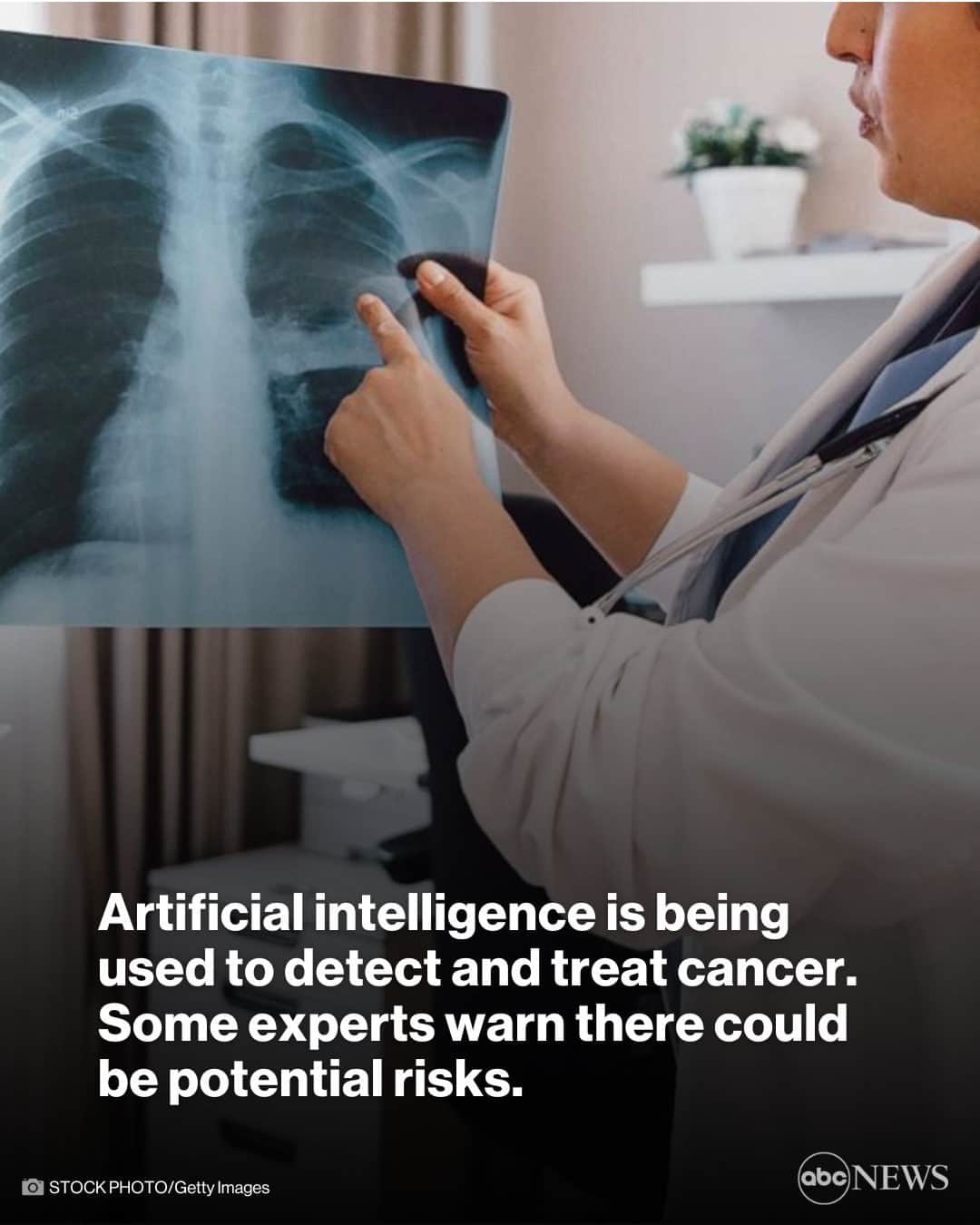 ABC Newsのインスタグラム：「Artificial intelligence is being used to help treat patients or communicate with patients about the complexities surrounding their cancer treatments. But some experts warn that there are drawbacks. Tap link in bio for more.」