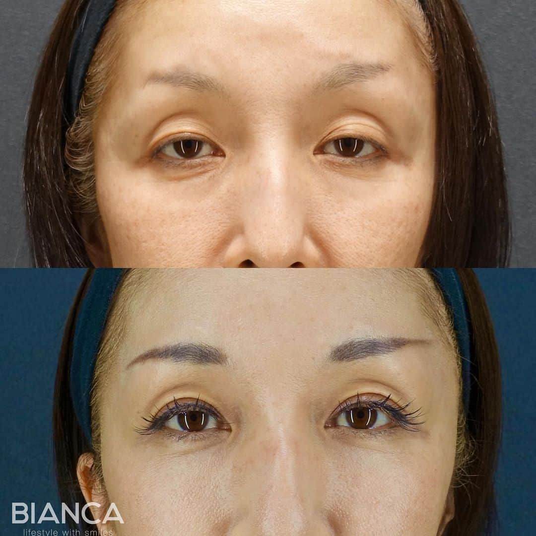 辻沢由有（BIANCA CLNIC 表参道院 院長）さんのインスタグラム写真 - (辻沢由有（BIANCA CLNIC 表参道院 院長）Instagram)「#dryuu目　#dryuu二重  ▶︎swipeで文字なし&別角度症例写真▶︎  窪み目と目の開きの悪さ。 根本解決は切開法ですが、なかなか踏み出せない方は埋没のMT法でもある程度の改善が見込めます😊  今後残った目の上のくぼみに、ヒアルロン酸も少量入れると更に綺麗になりそうなのでご提案もしています😊  上　術前 下　術後1か月  MT法は、特殊な極細⽷でまぶたの裏側の筋⾁を縫い縮めることで⽬の開きを良くする⼿術です。  🌸瞼の開きが悪く⿊⽬が隠れる 🌸眠そうに⾒える 🌸⽬つきが悪いと⾔われる  💉眼瞼下垂（MT法） 💴税込365,580円 😷腫れ 内出血:数日〜1週間程度  *⑅୨୧ ----------------------- ୨୧⑅*  お肌•注入•お手術まで全て担当できます🥰 「何をして良いかわからない」 「ガッツリ変わりたい」「自然な変化が良い」etc...なんでもご相談ください✨  📝ご予約はwebが便利です✨ プロフィール欄のリンクからご予約ください。 ※医師指名可能（“大久保医師指名”をクリック） ※診察料はかかりません🙅‍♀️ ※表参道院勤務が9割となっています。  📍BIANCA CLINIC ※お電話頂くと自動音声通話に繋がります。 ✔︎表参道院 ☎️05018071593 東京都港区南青山5-11-10  南青山511ビル 2F ✔︎銀座院 ☎️05031964834 東京都中央区銀座1-8-19 キラリトギンザ12F  •診療時間 10:00〜19:00 •年中無休（年末年始を除く）   #二重切開 #二重埋没 #二重整形 #埋没法#二重埋没法 #タッキング #切らない眼瞼下垂症手術 #切らない眼瞼下垂 #MT法 #眼瞼下垂手術 #眼瞼下垂 #くぼみ目 #くぼみ目改善」7月23日 13時57分 - i_am_yuu__