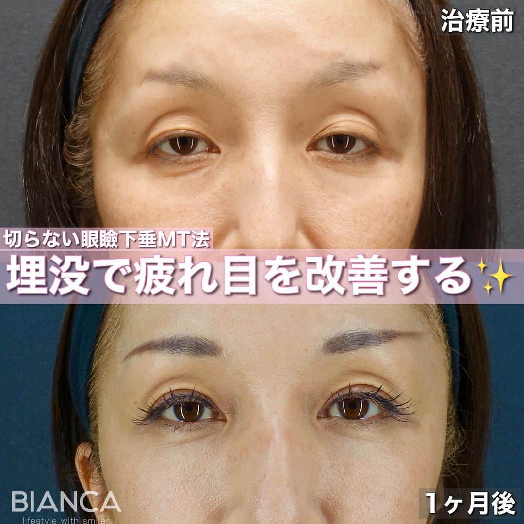 辻沢由有（BIANCA CLNIC 表参道院 院長）さんのインスタグラム写真 - (辻沢由有（BIANCA CLNIC 表参道院 院長）Instagram)「#dryuu目　#dryuu二重  ▶︎swipeで文字なし&別角度症例写真▶︎  窪み目と目の開きの悪さ。 根本解決は切開法ですが、なかなか踏み出せない方は埋没のMT法でもある程度の改善が見込めます😊  今後残った目の上のくぼみに、ヒアルロン酸も少量入れると更に綺麗になりそうなのでご提案もしています😊  上　術前 下　術後1か月  MT法は、特殊な極細⽷でまぶたの裏側の筋⾁を縫い縮めることで⽬の開きを良くする⼿術です。  🌸瞼の開きが悪く⿊⽬が隠れる 🌸眠そうに⾒える 🌸⽬つきが悪いと⾔われる  💉眼瞼下垂（MT法） 💴税込365,580円 😷腫れ 内出血:数日〜1週間程度  *⑅୨୧ ----------------------- ୨୧⑅*  お肌•注入•お手術まで全て担当できます🥰 「何をして良いかわからない」 「ガッツリ変わりたい」「自然な変化が良い」etc...なんでもご相談ください✨  📝ご予約はwebが便利です✨ プロフィール欄のリンクからご予約ください。 ※医師指名可能（“大久保医師指名”をクリック） ※診察料はかかりません🙅‍♀️ ※表参道院勤務が9割となっています。  📍BIANCA CLINIC ※お電話頂くと自動音声通話に繋がります。 ✔︎表参道院 ☎️05018071593 東京都港区南青山5-11-10  南青山511ビル 2F ✔︎銀座院 ☎️05031964834 東京都中央区銀座1-8-19 キラリトギンザ12F  •診療時間 10:00〜19:00 •年中無休（年末年始を除く）   #二重切開 #二重埋没 #二重整形 #埋没法#二重埋没法 #タッキング #切らない眼瞼下垂症手術 #切らない眼瞼下垂 #MT法 #眼瞼下垂手術 #眼瞼下垂 #くぼみ目 #くぼみ目改善」7月23日 13時57分 - i_am_yuu__